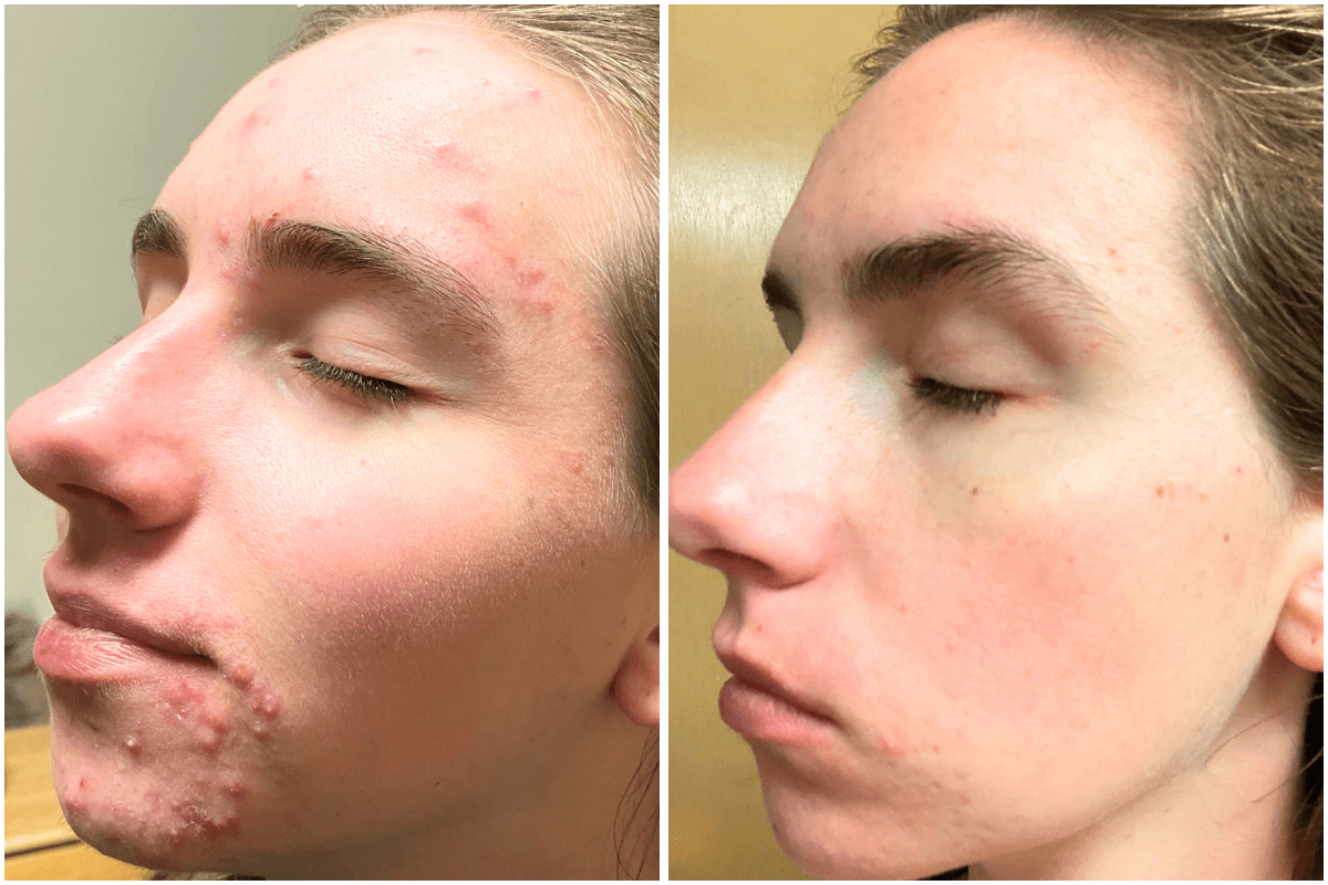 acne-treatment-Viva-Carmel-by-the-Sea-aesthetic-dermatology-medspa-results-transformation-products-before-after-3.png