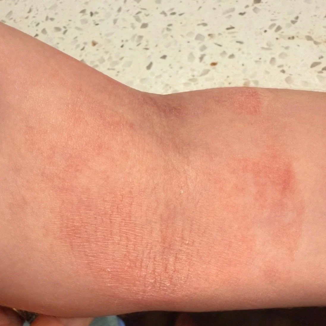 Eczema