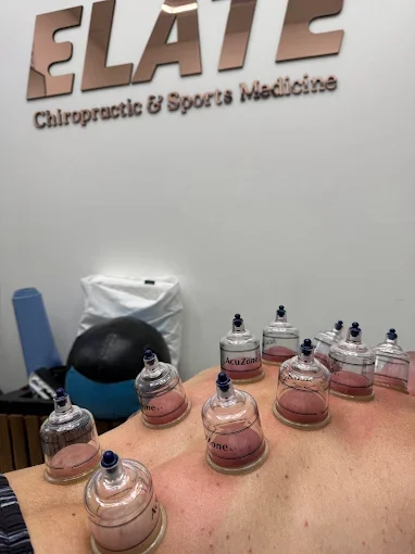 Cupping Therapy in San Diego: What It Is, What It’s For, and Who It Helps