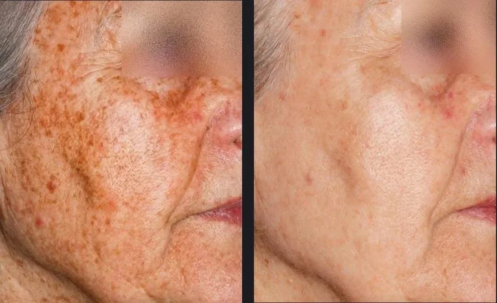 Side-by-side comparison of a person's face showing significant reduction in freckles and pigmentation, indicating skin treatment results.
