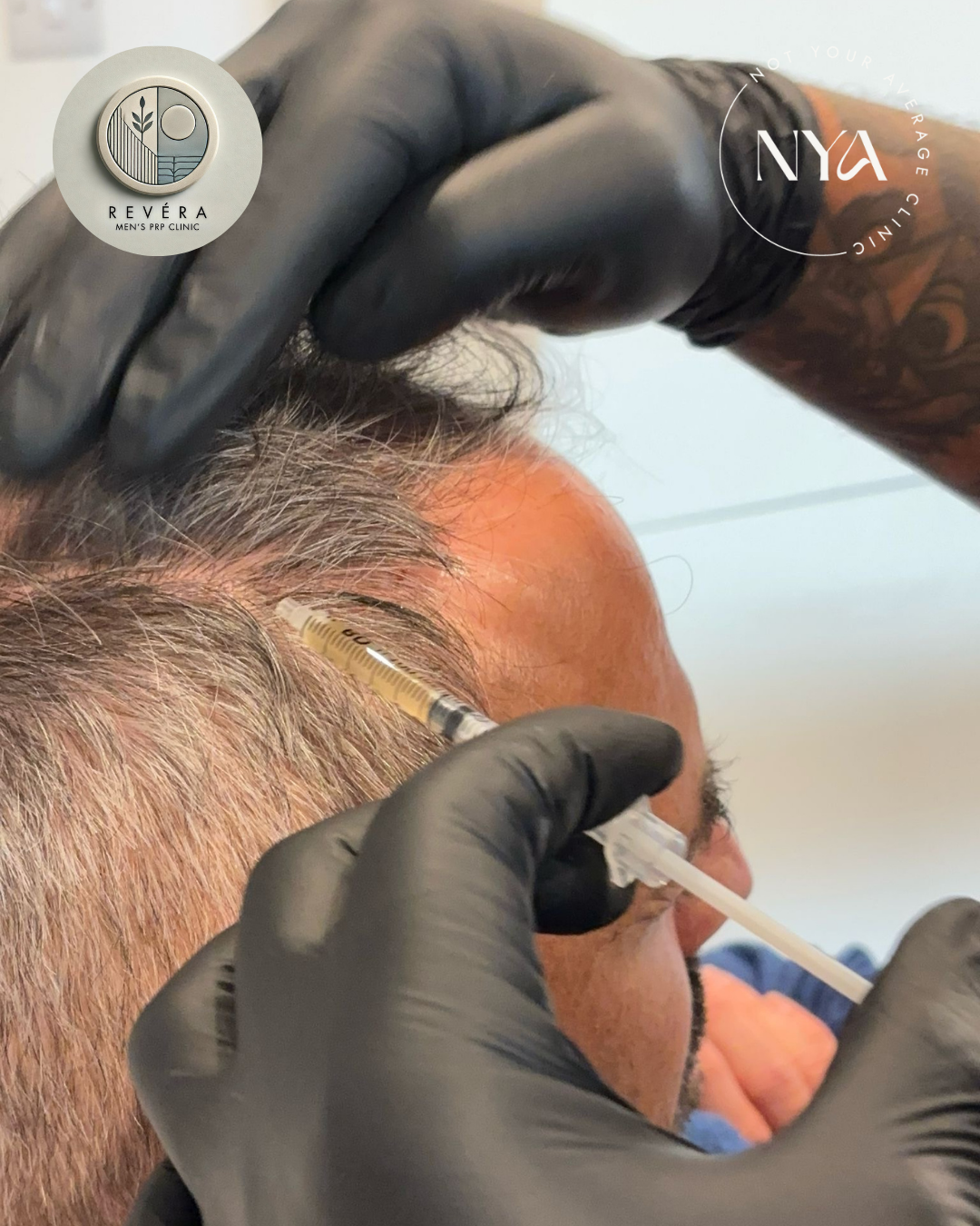 A person receiving a skin treatment injection into their forehead, wearing black gloves, with logos for Revera Men's PRP Clinic and NYA in the background.