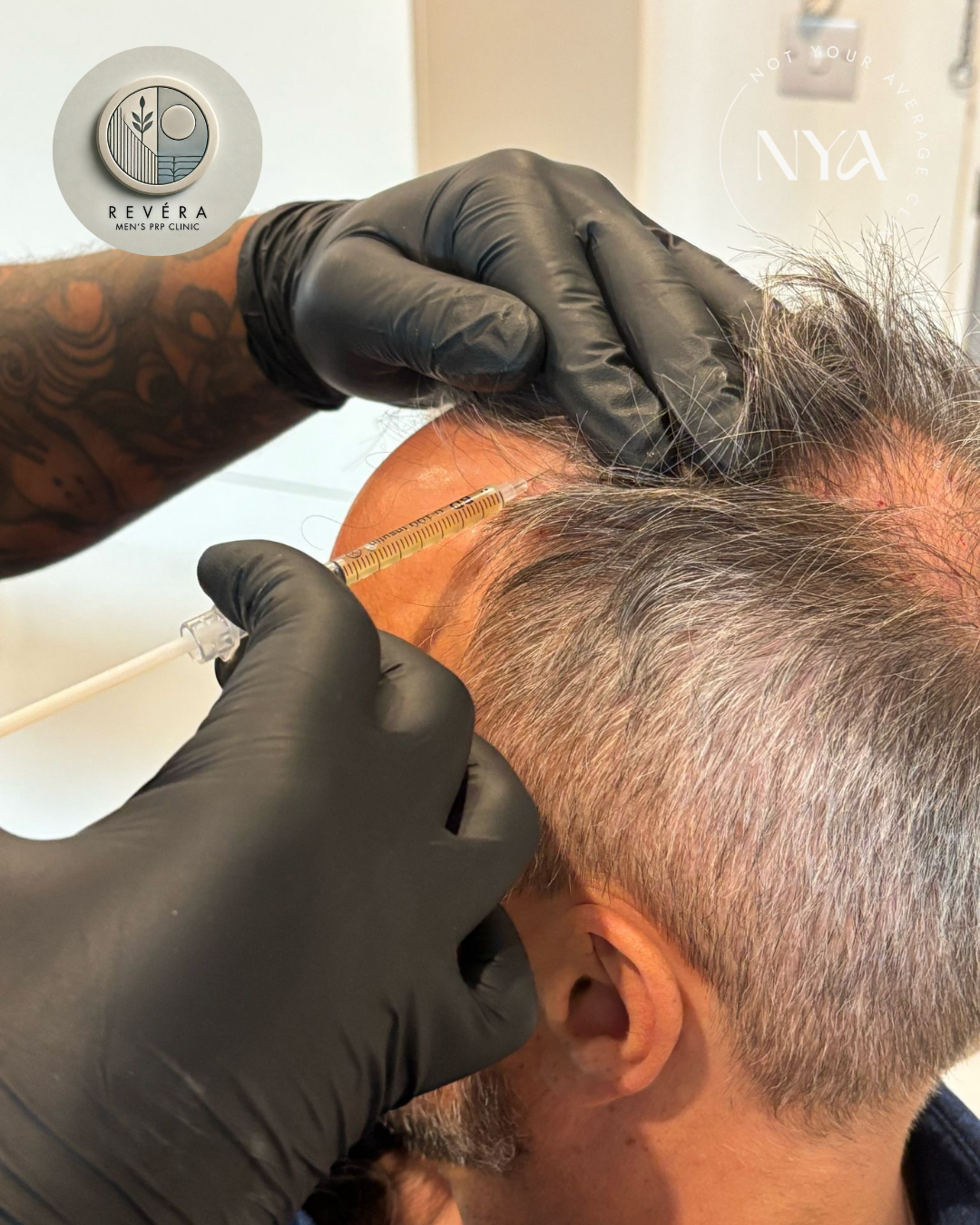 A person receiving a cosmetic injection in their forehead by a professional wearing black gloves, with logos for Revera Men's PRP Clinic and NYA in the background.