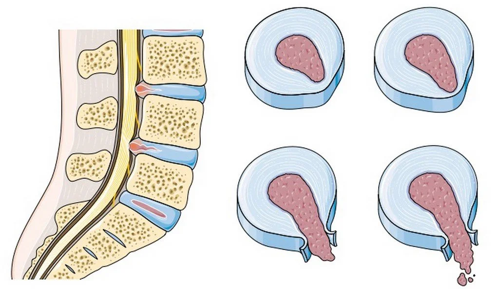 Tout savoir sur la hernie discale 