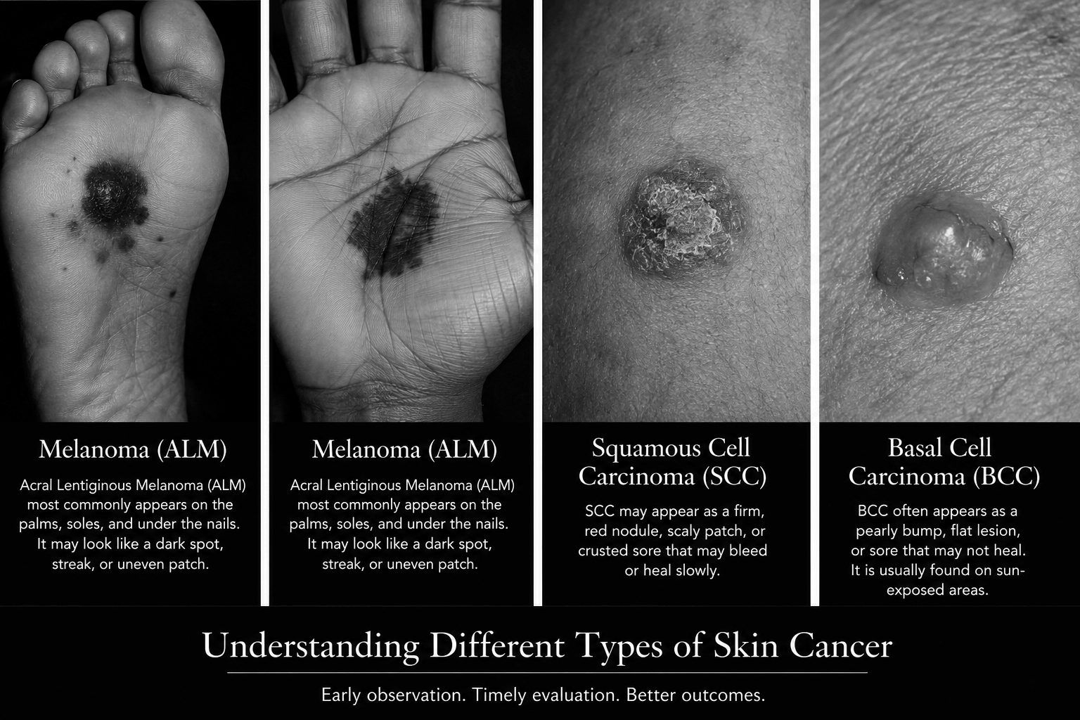 Skin Cancer, Melanin, and the Cost of Being Overlooked
