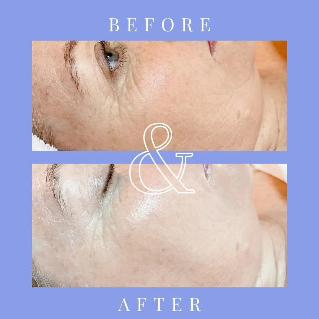 Amazing what professional skin treatments can do!! Love it! ❤️❤️❤️

#skintreatments#facialtreatments#agingskin#alameda#alamedaca