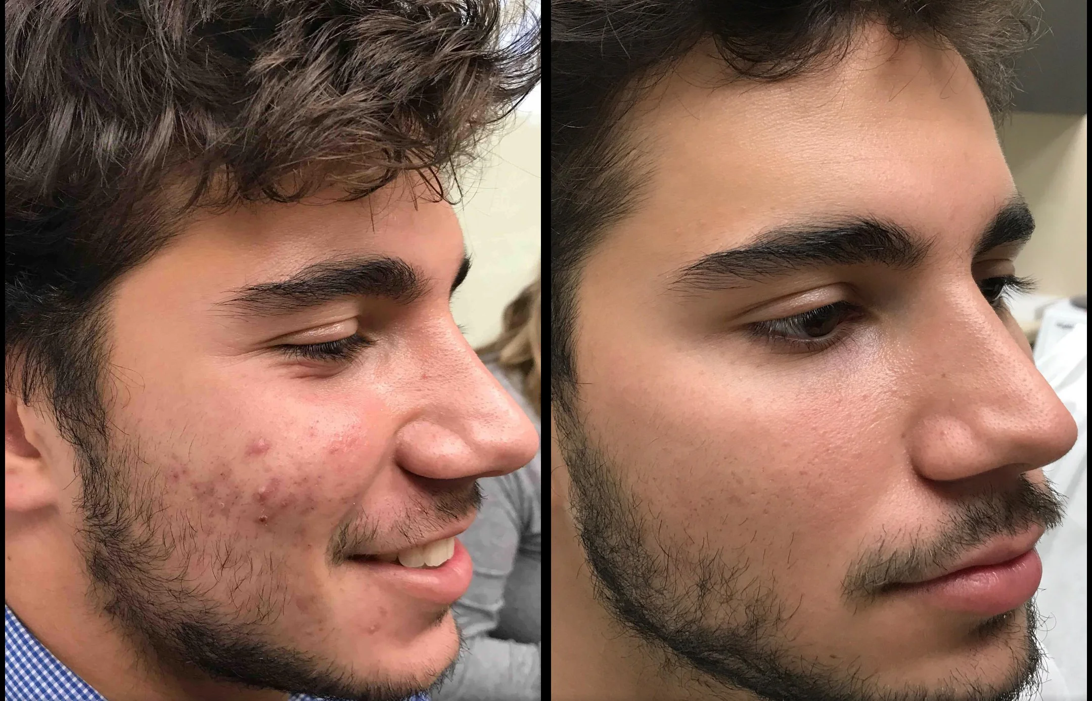 A side-by-side comparison of a man's face showing before and after skin treatment, with clear skin and reduced blemishes in the after image.