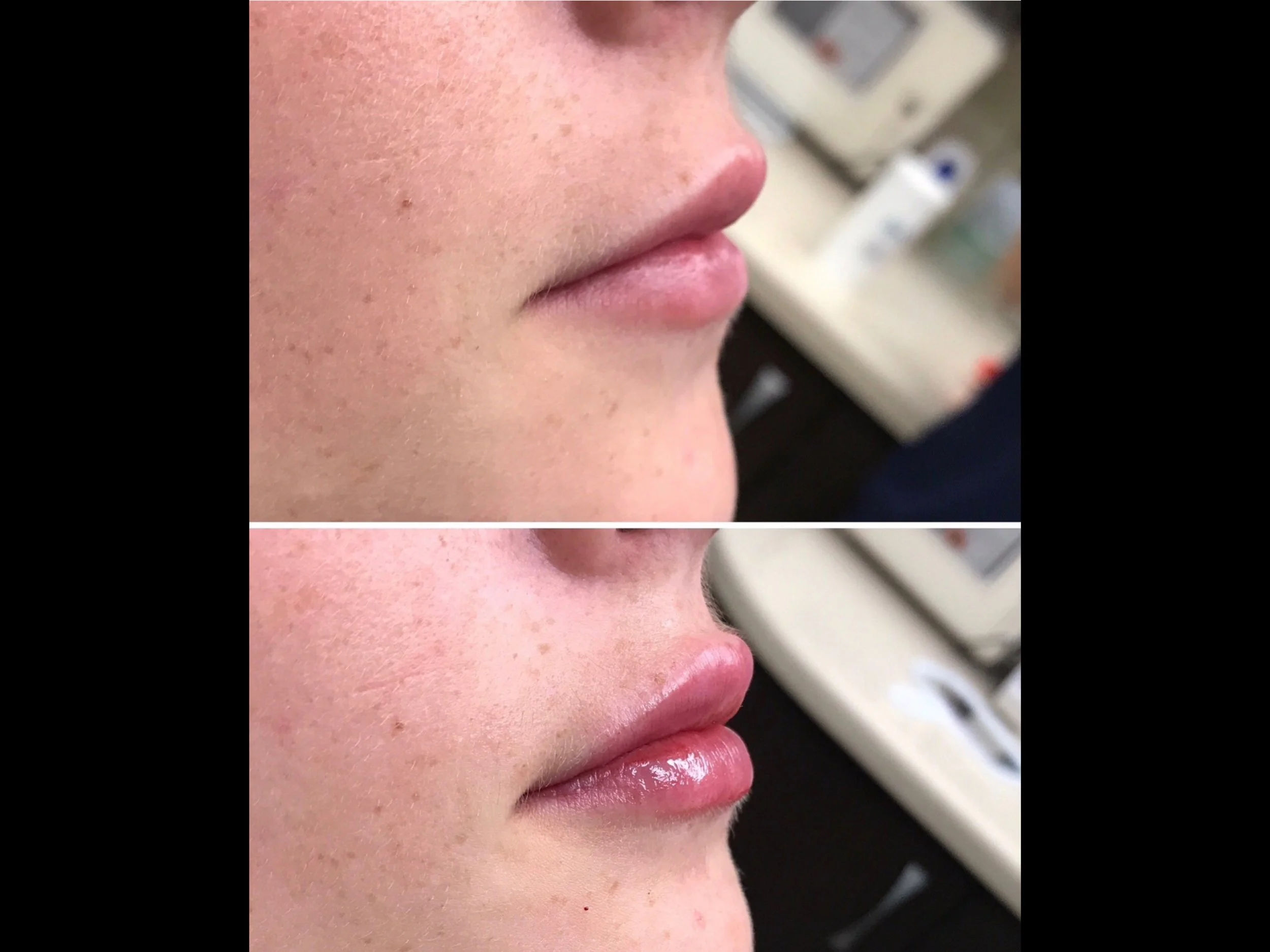 Close-up of a person's lips before and after applying lip gloss, showing smoother skin and shinier lips in the after image.