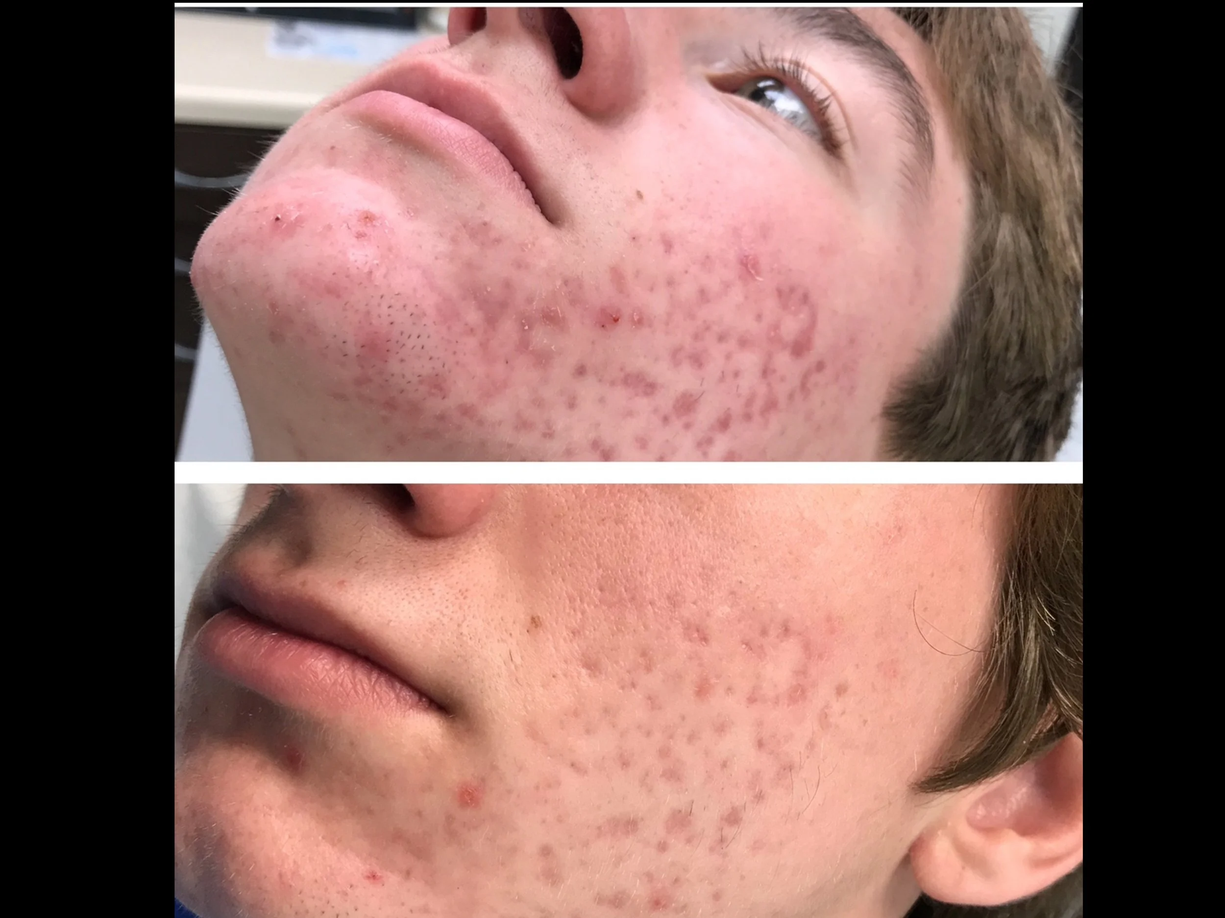 Close-up of a person's face showing a before and after comparison of skin with acne and scars, indicating improvement after treatment.