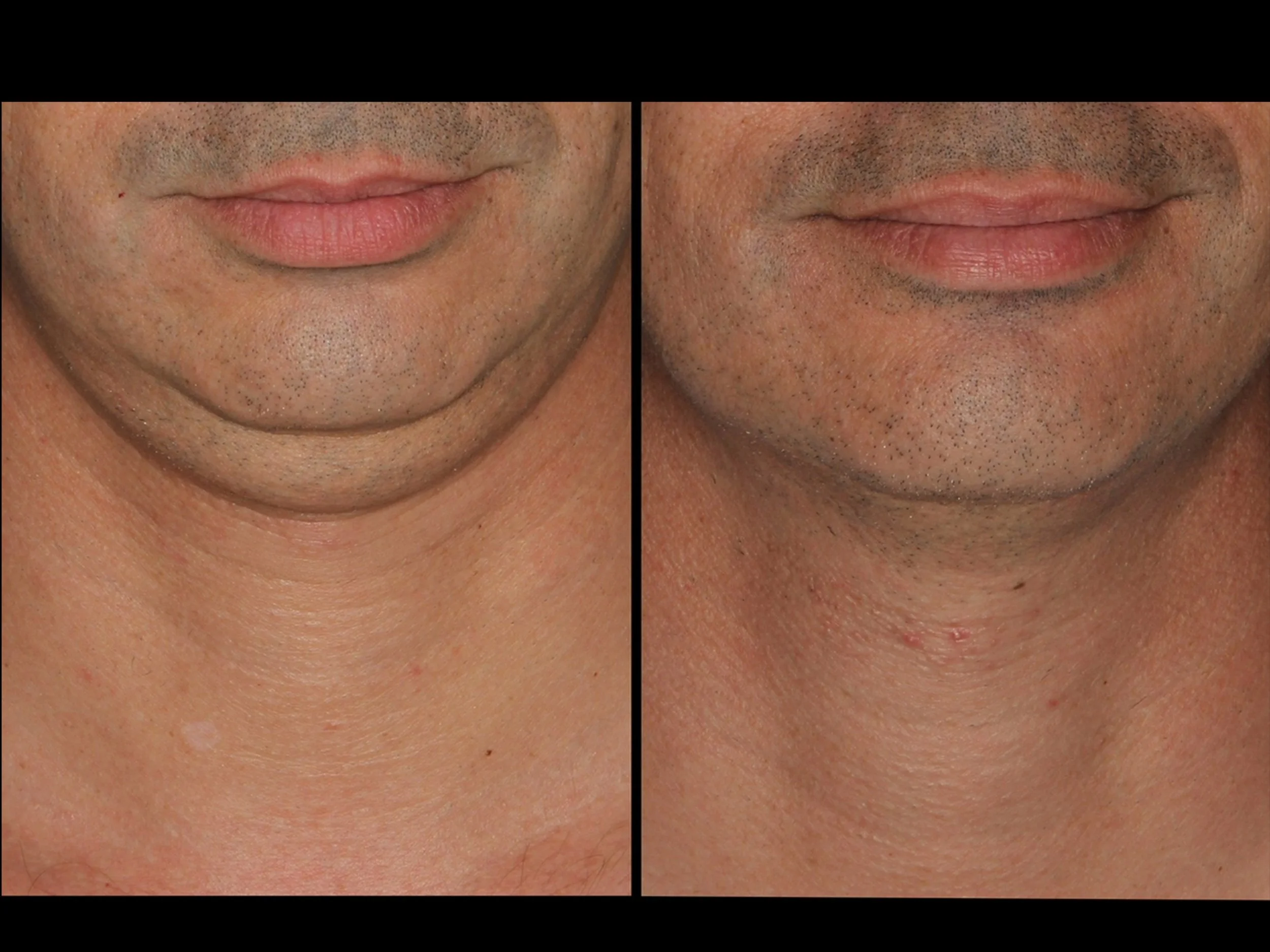 Close-up side-by-side of a person's chin and neck before and after skin treatment showing clearer skin and reduced wrinkles.
