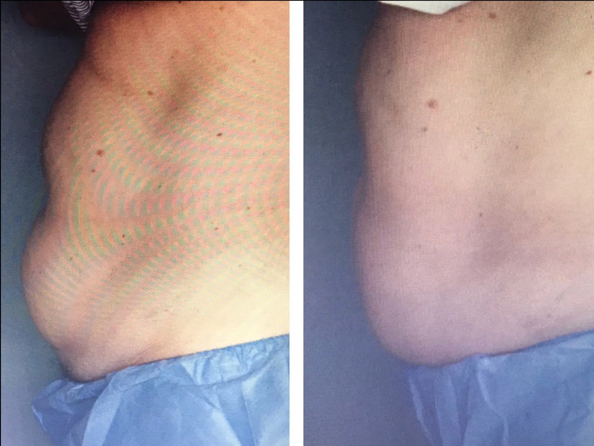 Comparison of a person's lower back before and after a treatment or procedure, showing improved skin condition on the right.