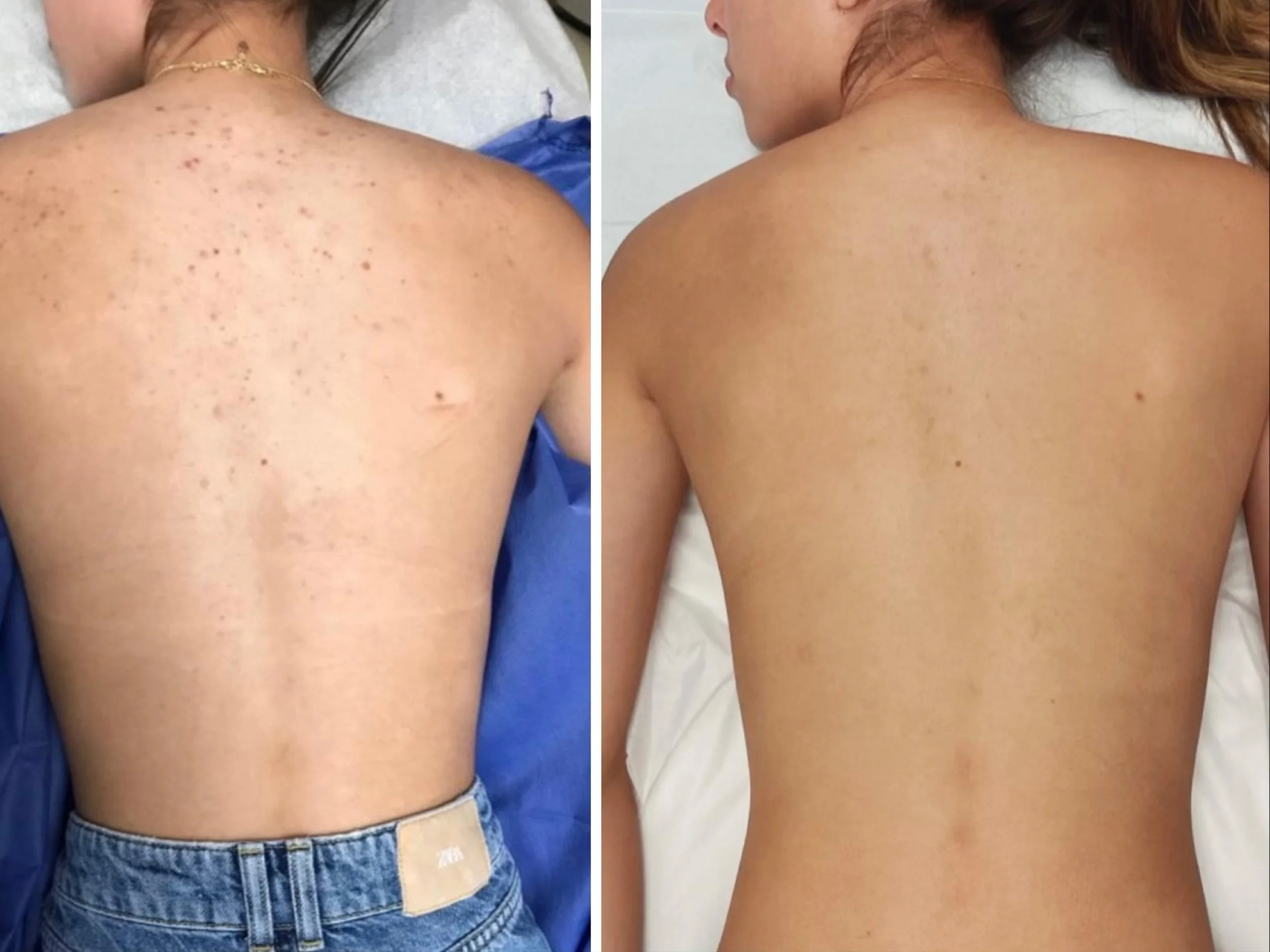 Comparison of a person's back before and after dermatological treatment showing clear skin on the right side with reduced acne scars and spots.