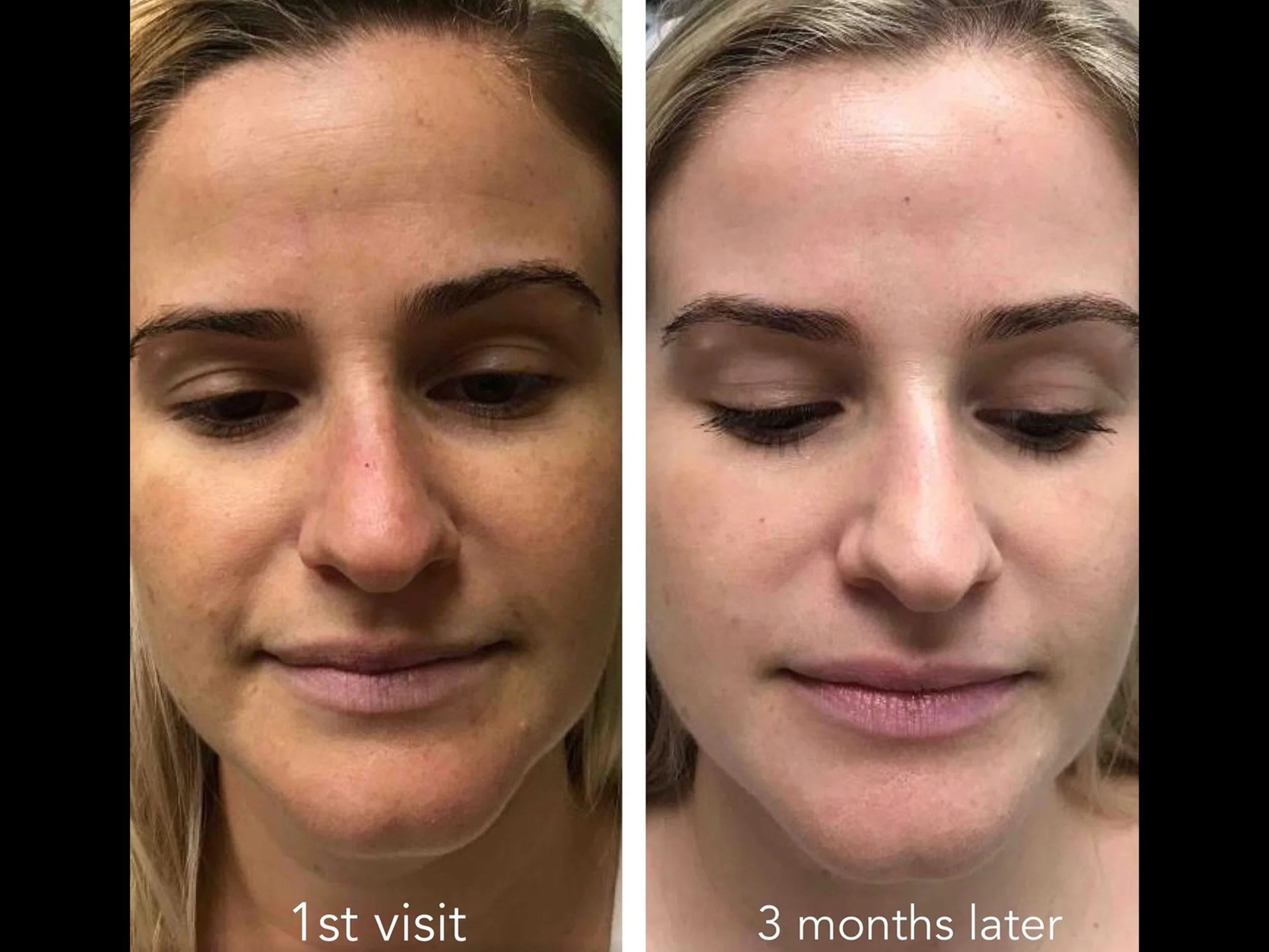 Comparison of a woman's face before and after skincare treatment, with text indicating '1st visit' on left and '3 months later' on right.