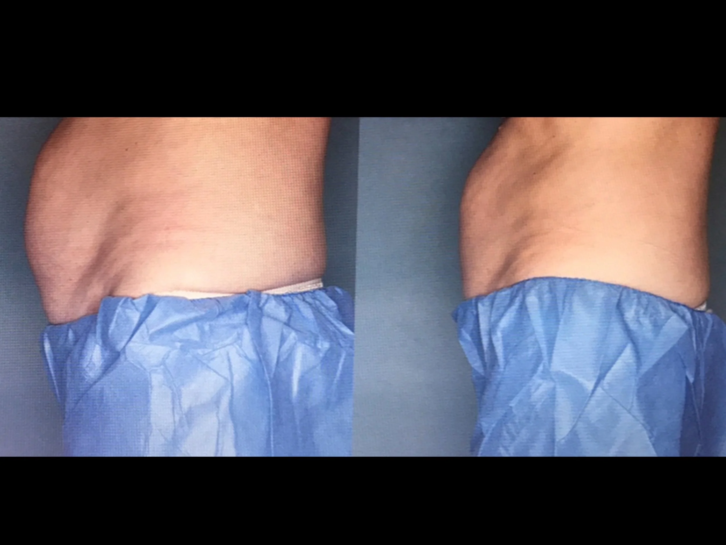 Comparison of a person's lower back and waist before and after a treatment or process, showing noticeable reduction in fat or skin folds.