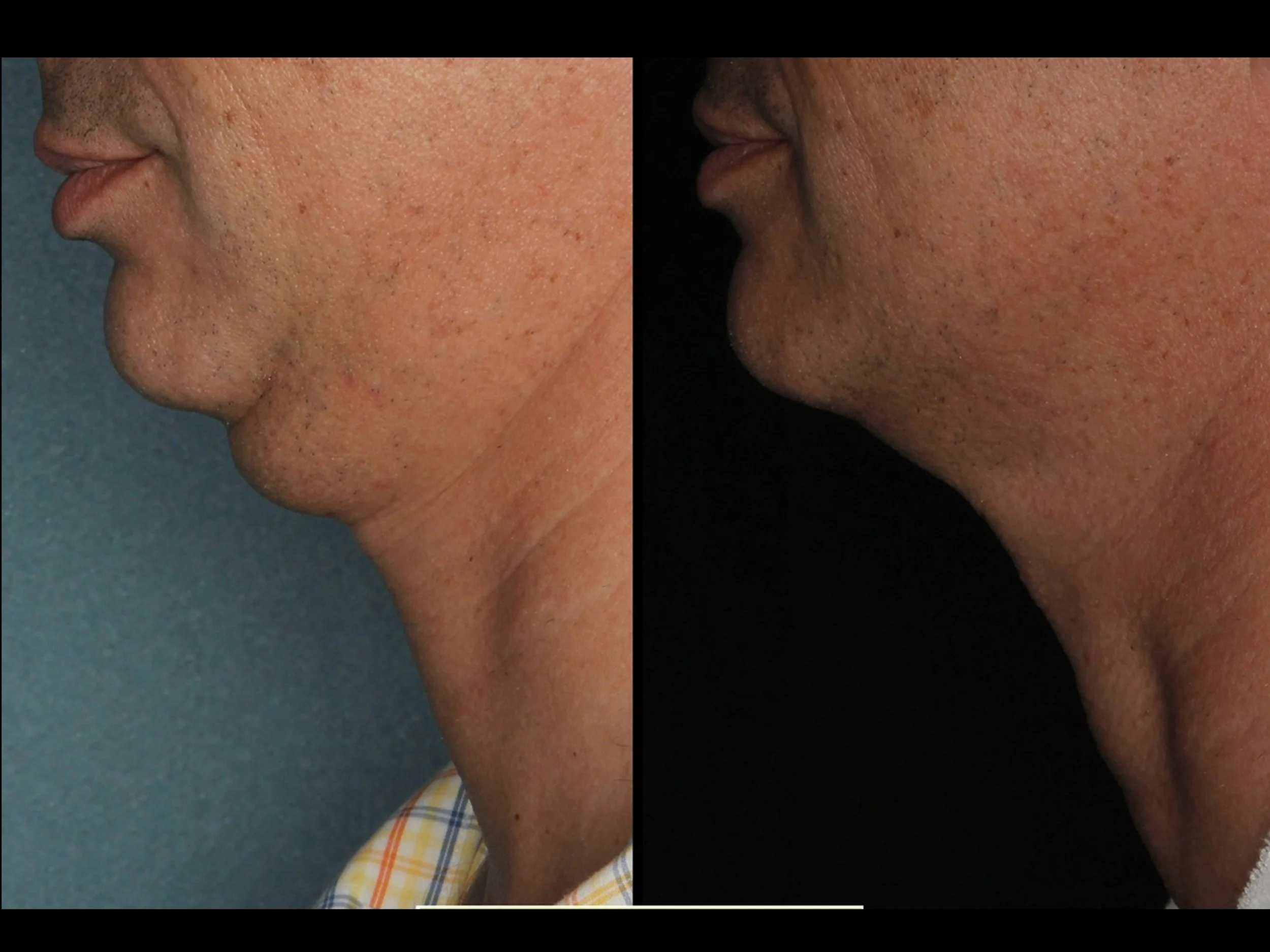 Side-by-side comparison of a person's chin and neck area before and after treatment, showing reduced fat and improved skin tightening.