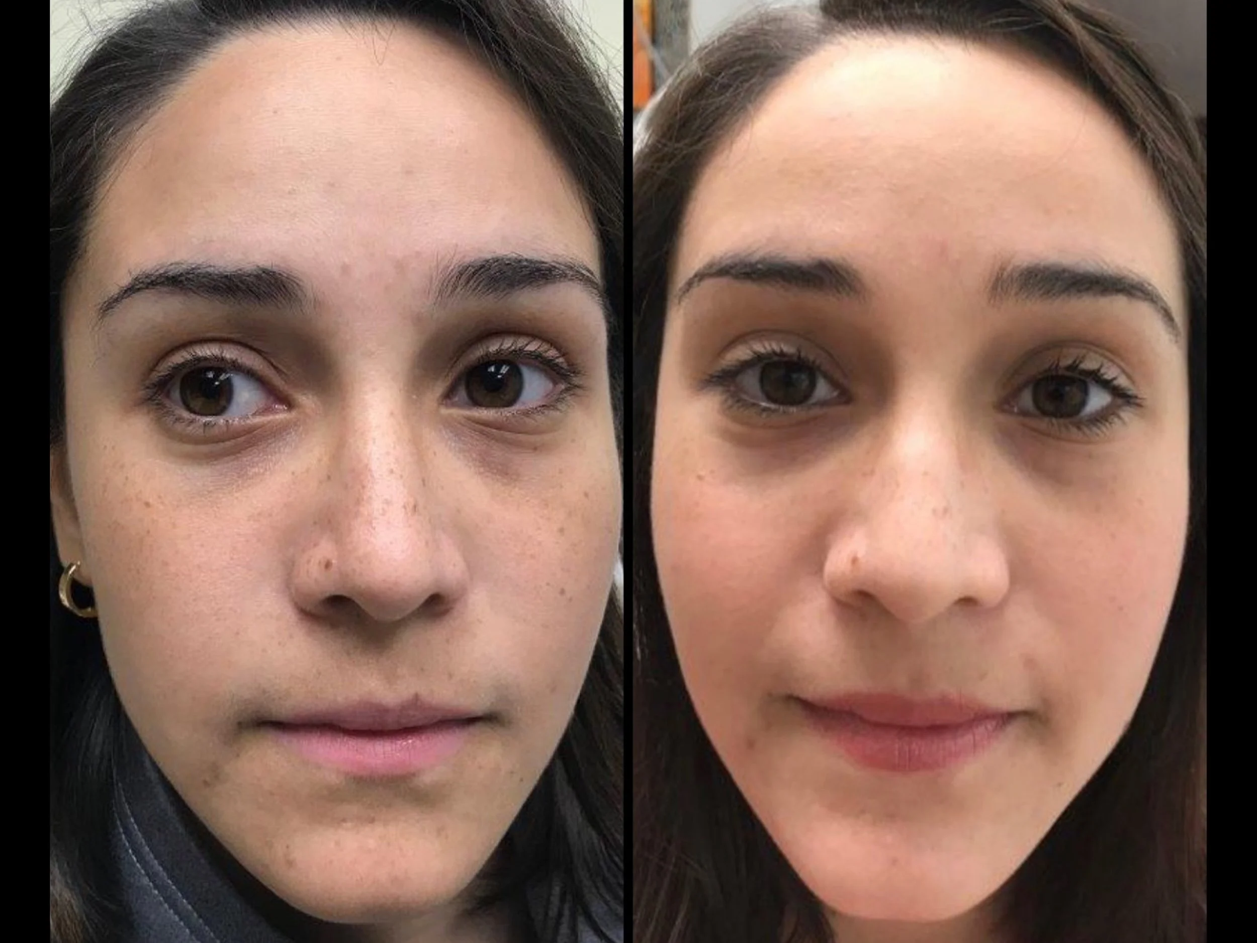 Side-by-side comparison of a woman's face before and after skincare or makeup, showing improved skin texture and tone.