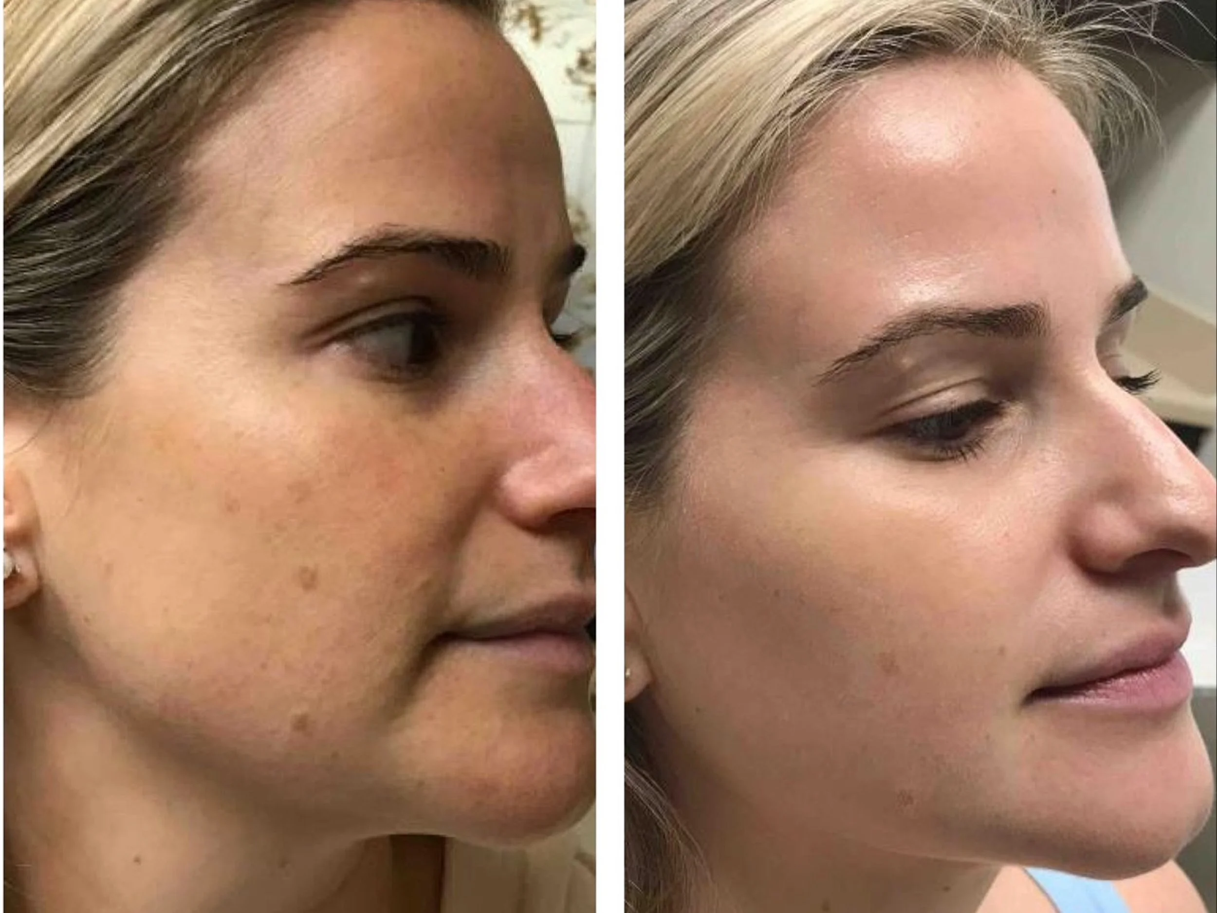 Side-by-side comparison of a woman's face before and after skin treatment, showing improvements in skin clarity, texture, and complexion.