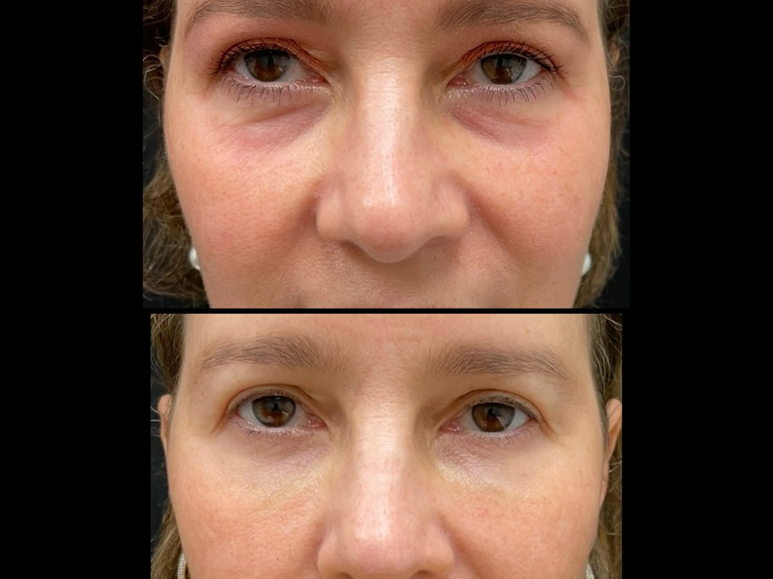 Close-up of woman's face showing before and after cosmetic treatment around the eyes, with the top image displaying puffiness and dark circles, and the bottom image showing reduced puffiness and brighter skin.