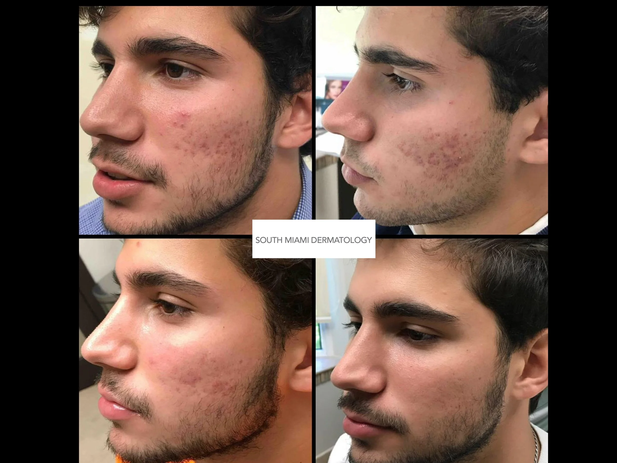 Before and after images of a man’s face showing acne improvement, provided by South Miami Dermatology.