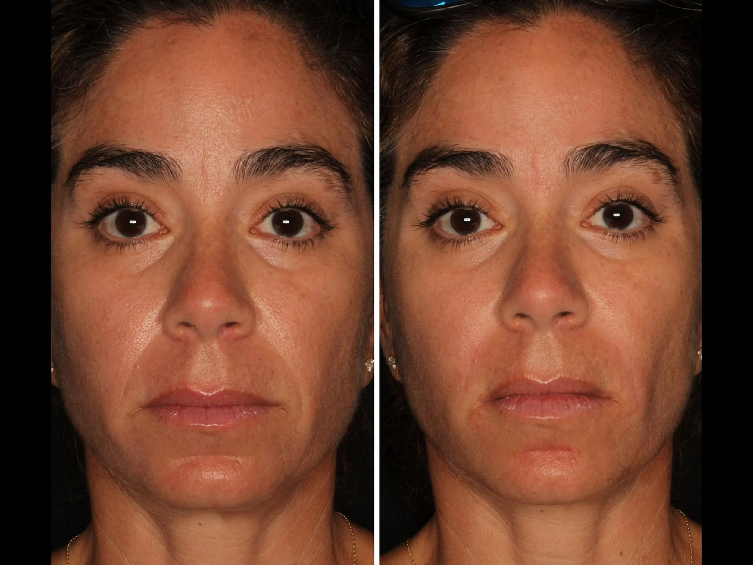 Comparison of a woman's face before and after a skincare treatment, showing improvements in skin texture and appearance.