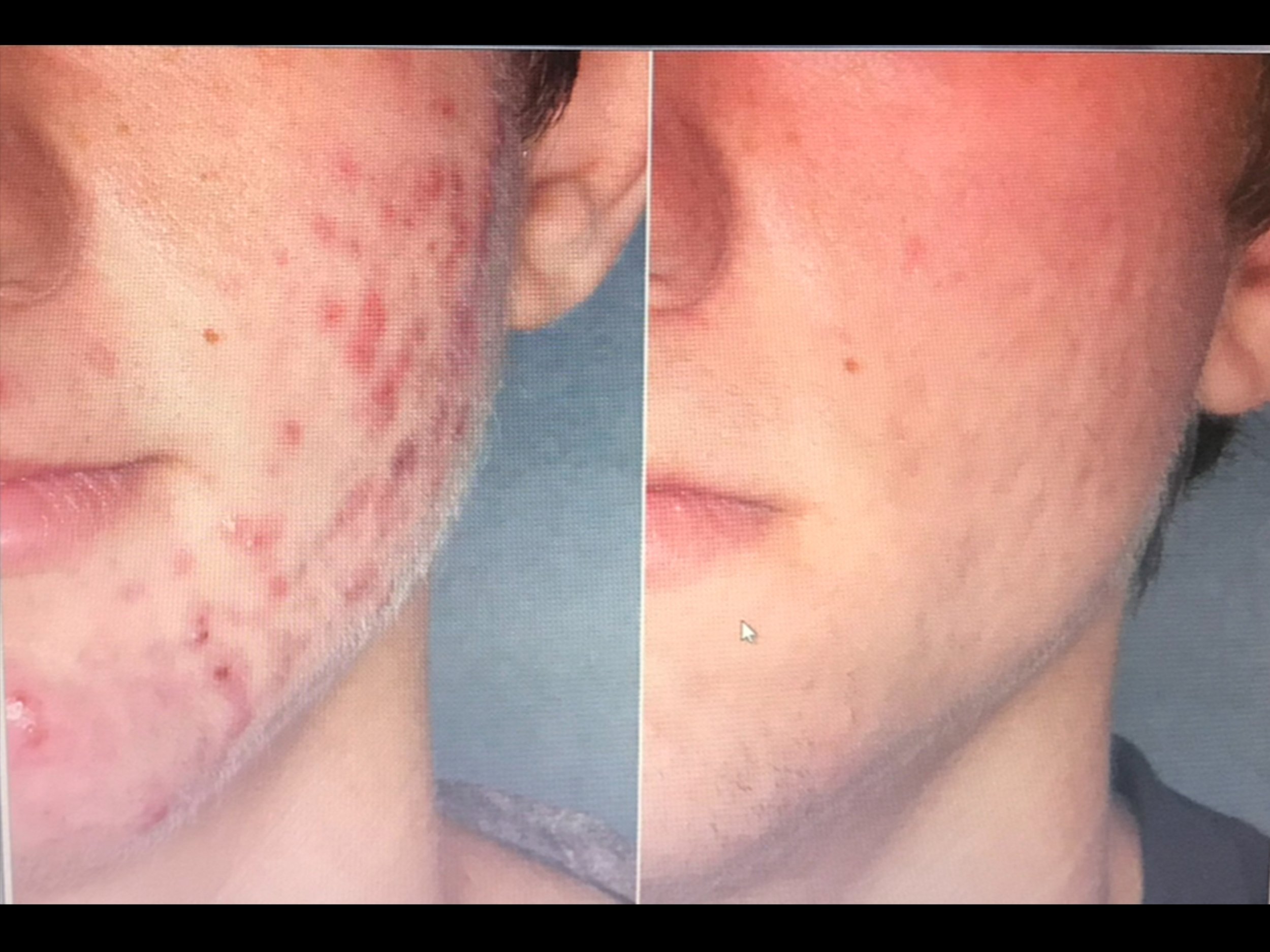 Side-by-side comparison of a person's face before and after acne treatment, showing significant improvement in skin condition.