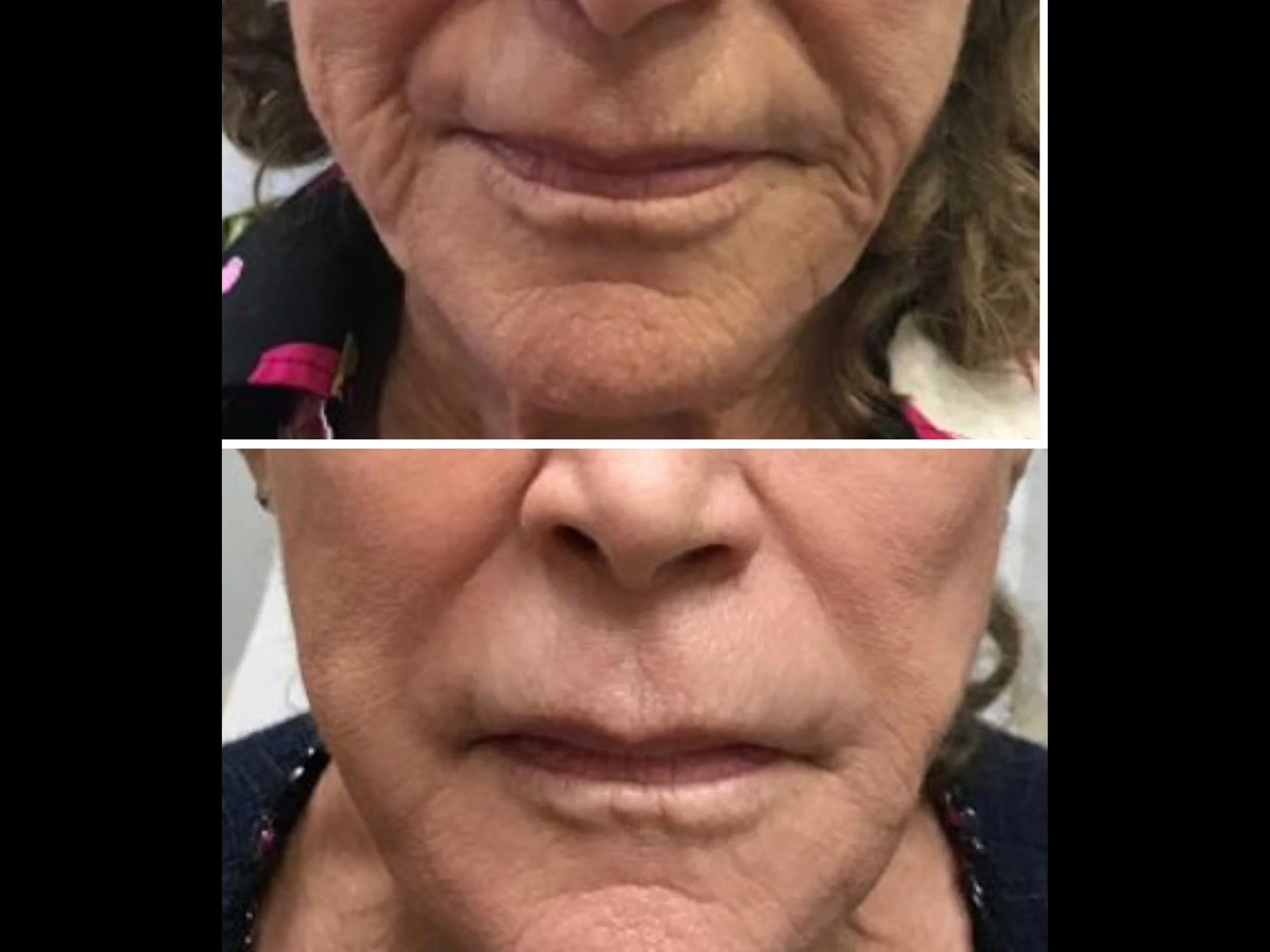 Close-up comparison of a woman's face before and after a cosmetic procedure, showing smoother skin and reduced wrinkles in the after image.