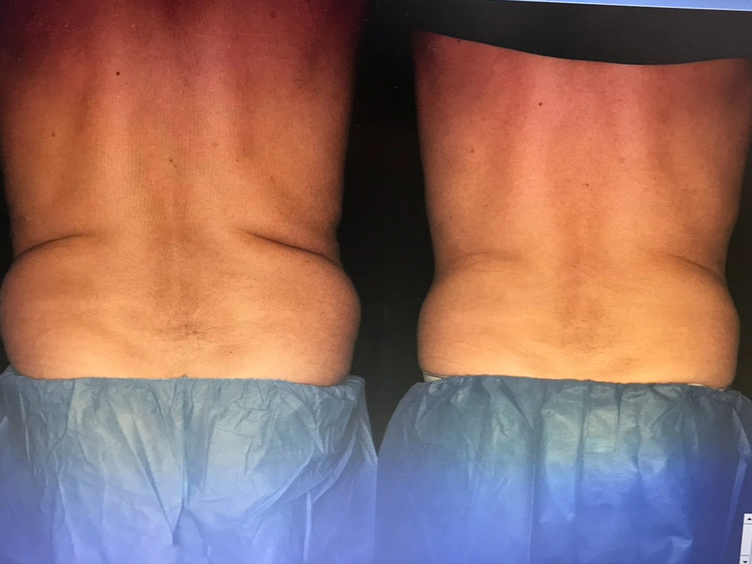 Back view of a person's lower back and hips, with visible folds of skin and wearing blue disposable underwear, against a dark background.