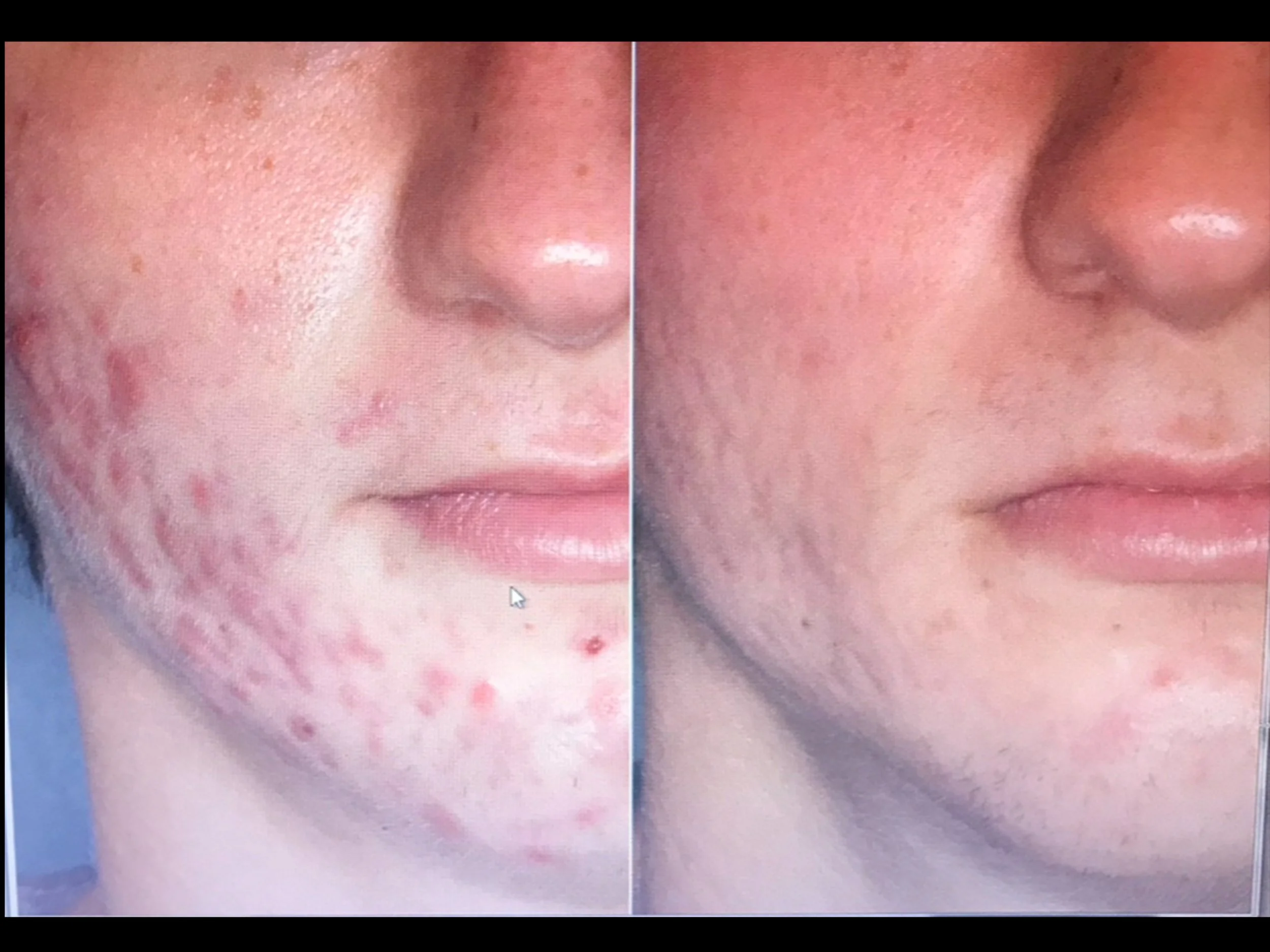 Close-up side-by-side comparison of a person's face showing severe acne on the left side and clear skin on the right side.