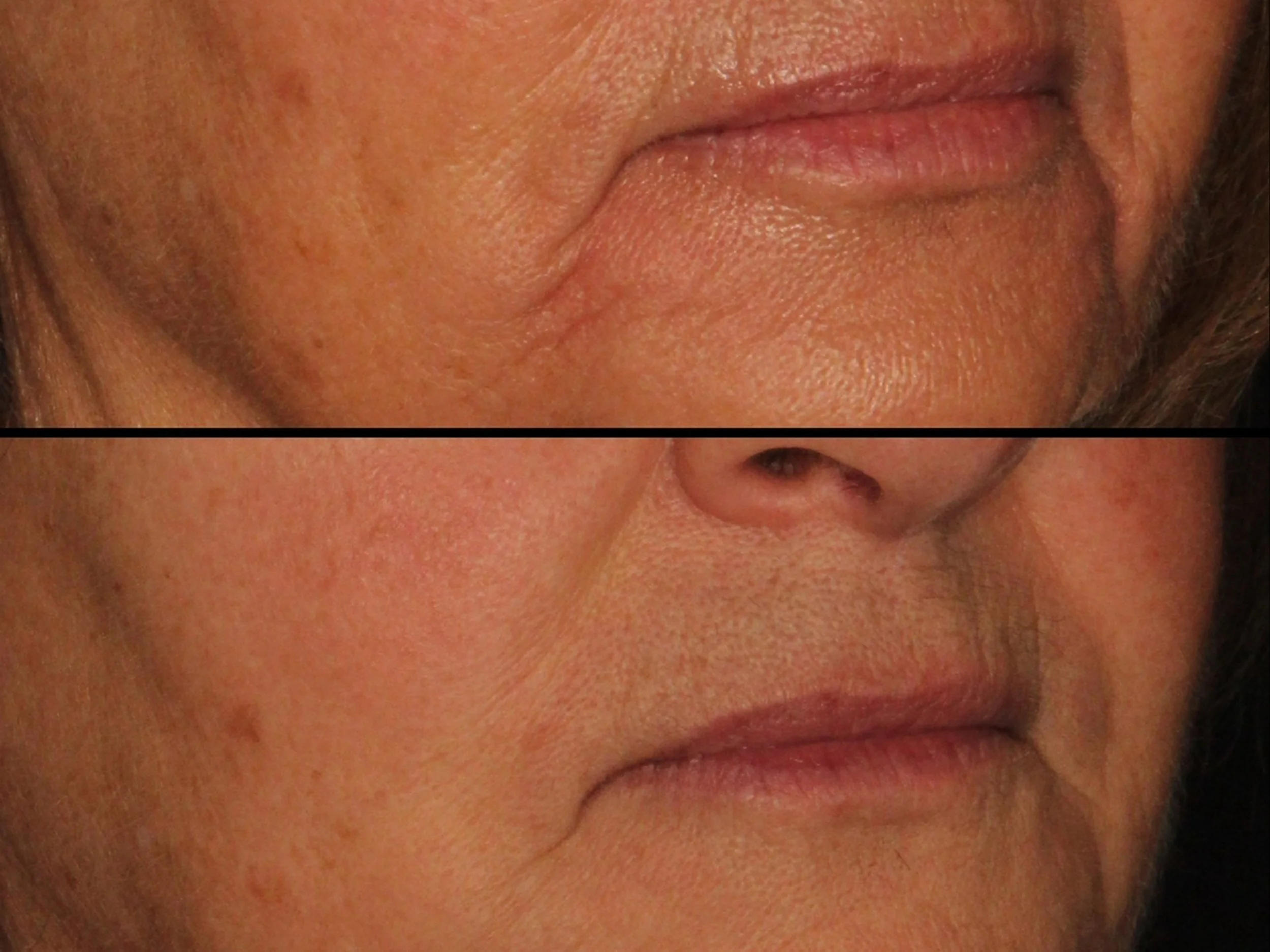 Close-up photographs showing the lower face of a person, with the top image illustrating skin with wrinkles and acne scars, and the bottom image showing smoother, clearer skin.