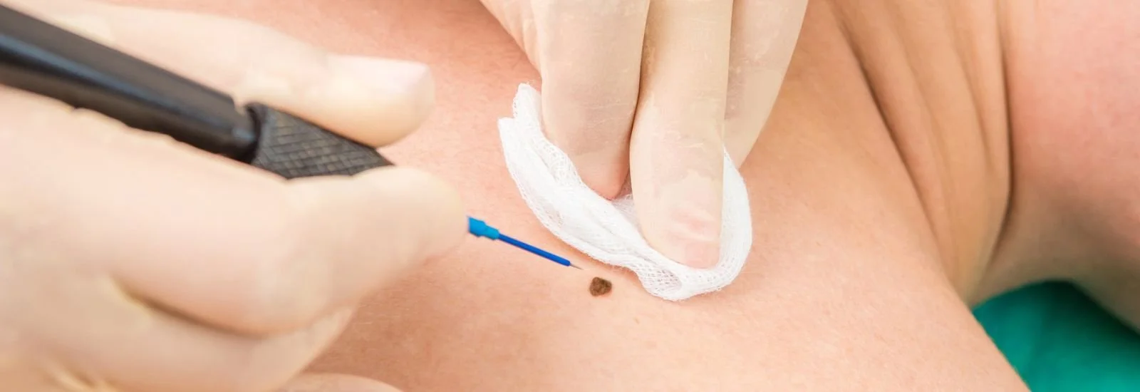 Close-up of a medical procedure where a healthcare professional is inserting a needle with a blue tip into a mole on a person's skin, using a white gauze pad to wipe the area.