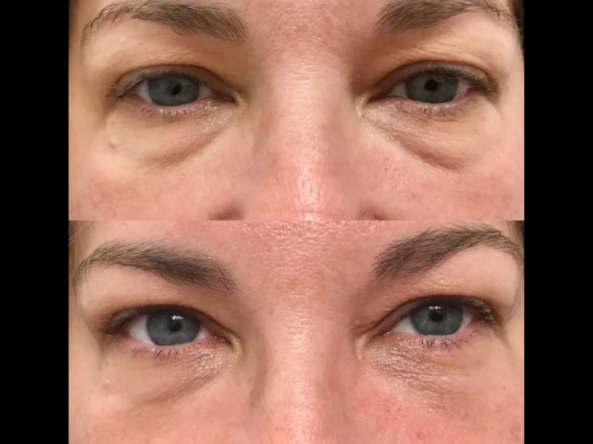 Comparison of a person's eye area before and after cosmetic treatment, showing reduced under-eye bags and smoother skin in the second image.
