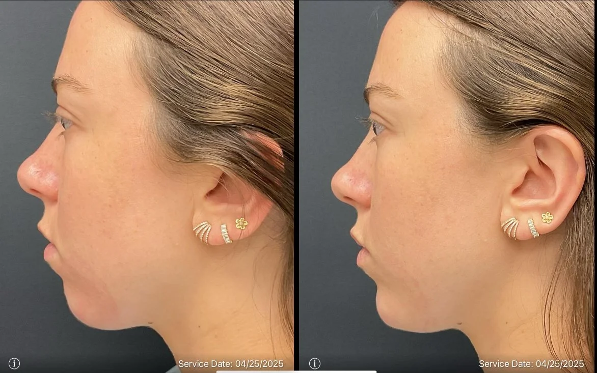 Side-by-side comparison of a woman's profile before and after a cosmetic procedure, showing slight changes in facial contour and skin texture.