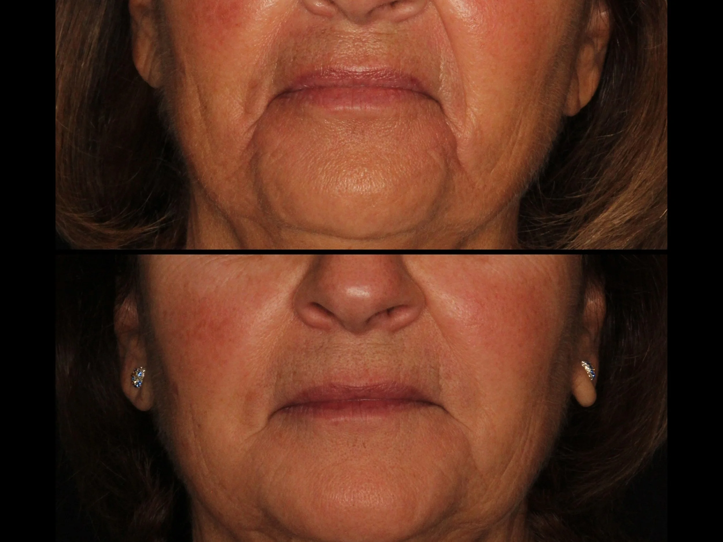 Close-up comparison of an elderly woman's face before and after cosmetic treatment, focusing on lower facial area showing smoother skin in the after image.