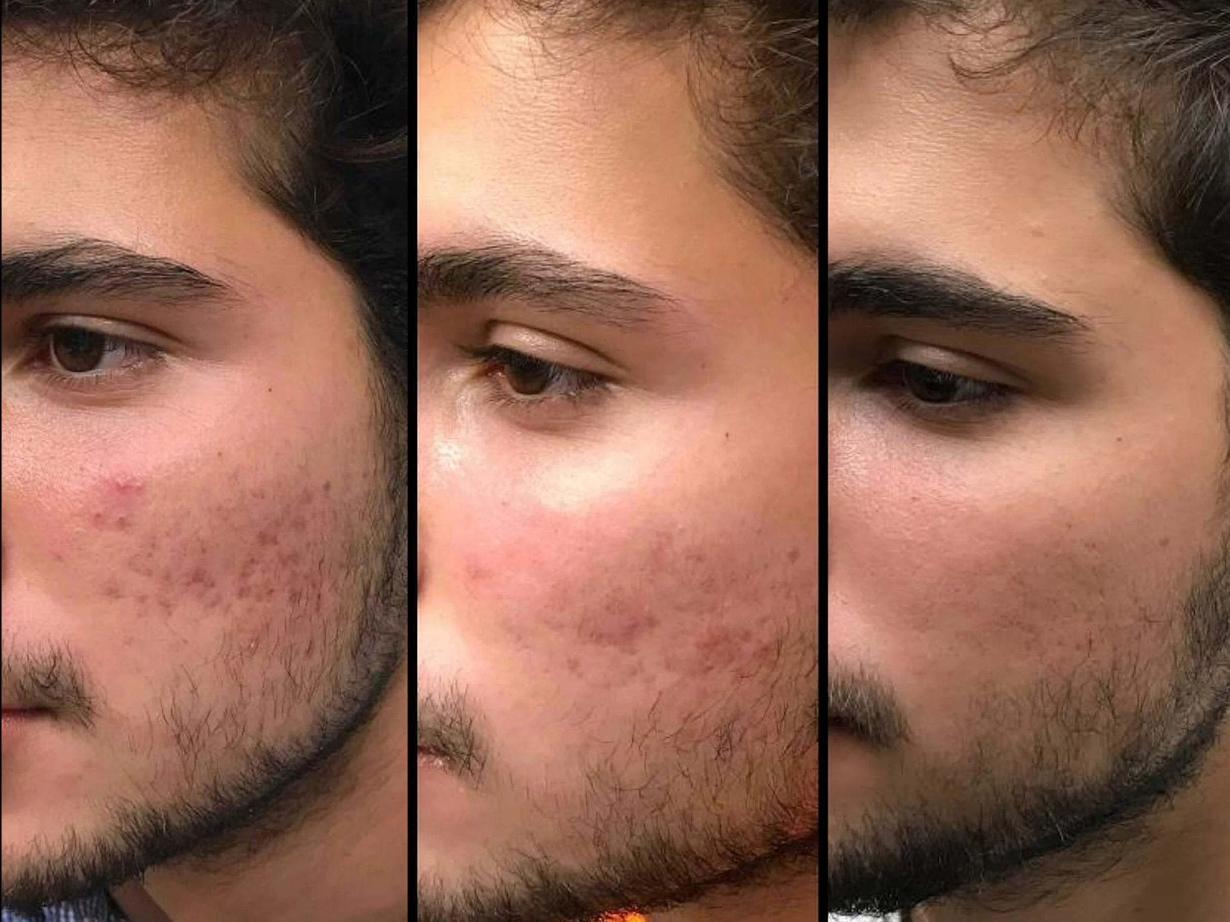 Close-up front and side views of a young man's face showing skin before, during, and after acne treatment.