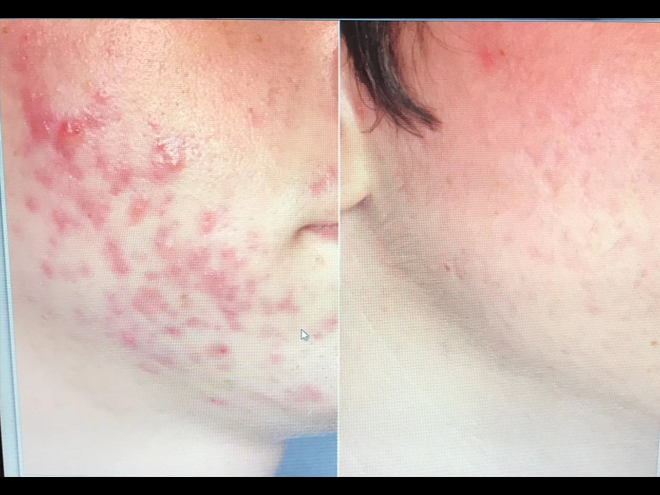 Comparison of skin with severe acne on the left side and clear skin on the right side.