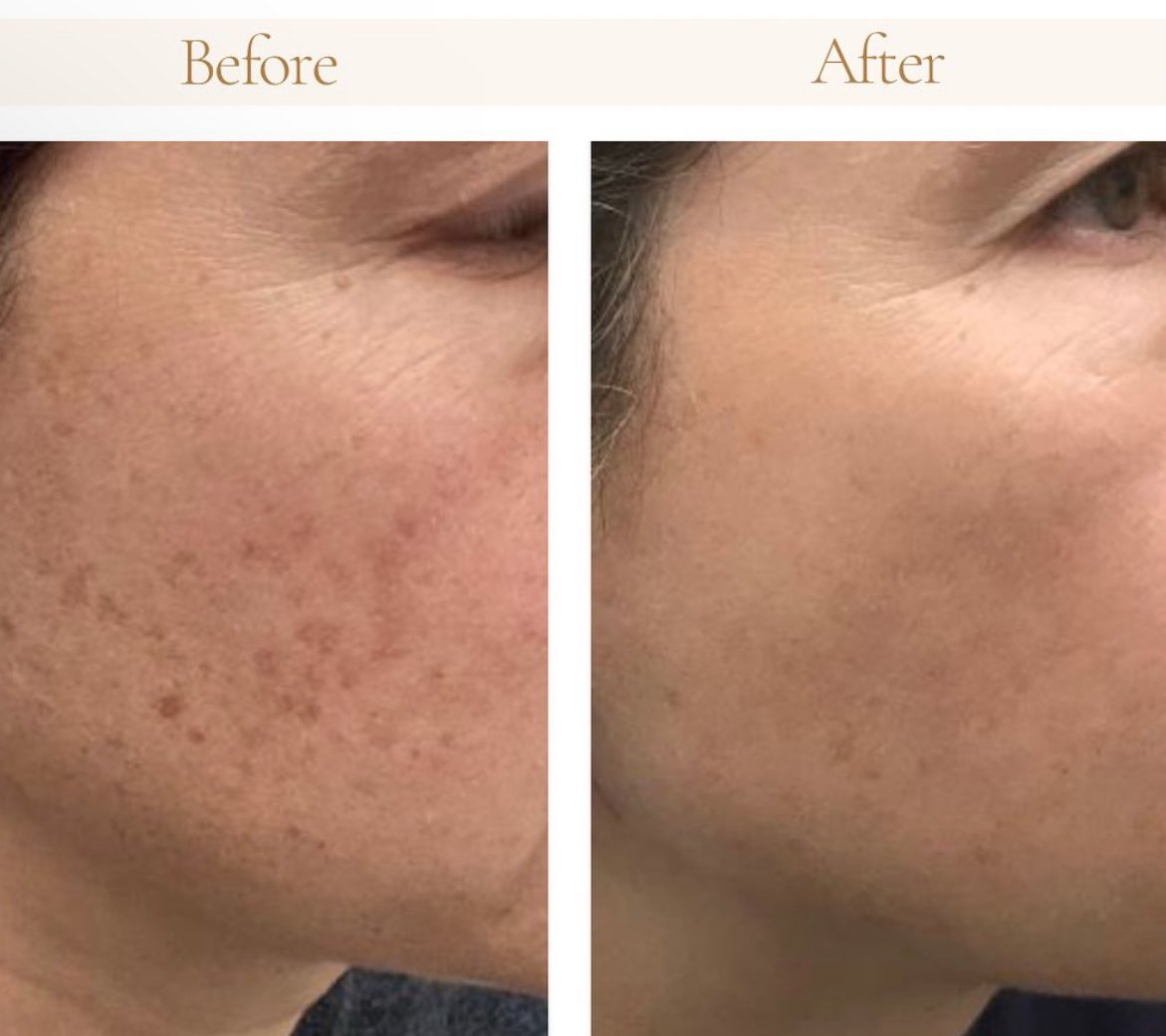 Side-by-side comparison of a woman's face showing skin with acne scars and pigmentation before and after skincare treatment, with clearer skin in the after image.