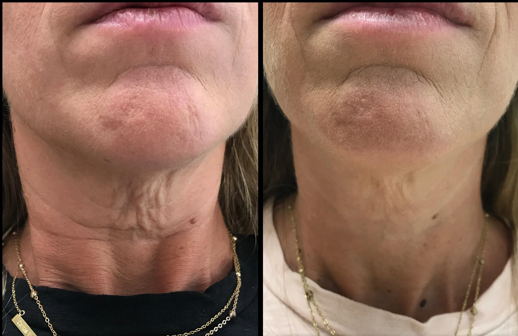 Close-up of a person's neck and lower face, showing skin condition improvement. Left side depicts dry, wrinkled skin with some uneven texture, while right side shows smoother, less wrinkled skin. The individual is wearing gold jewelry and a black top on the left and a light top on the right.