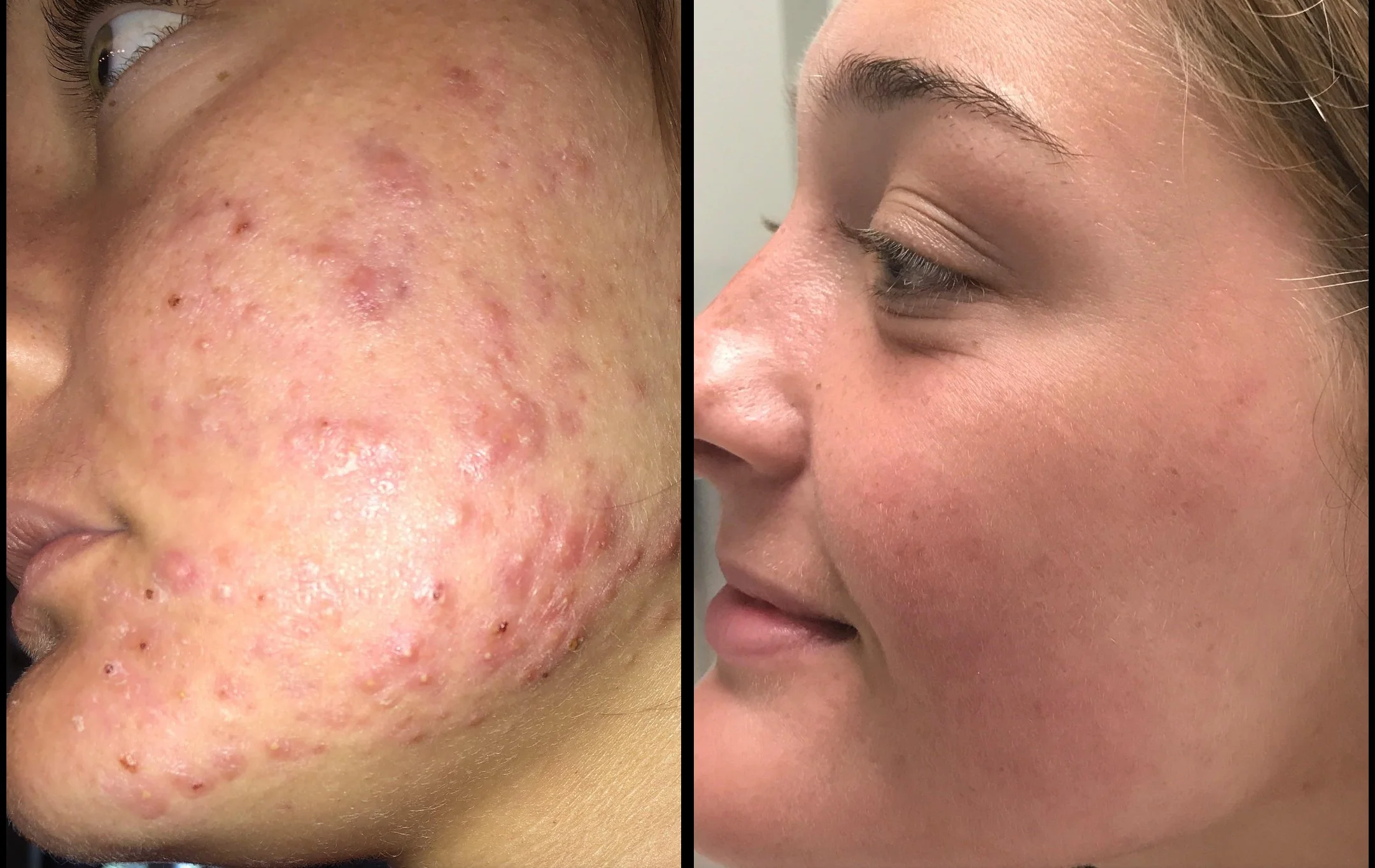 Side-by-side comparison of a woman's face showing severe acne on the left and clear skin on the right.