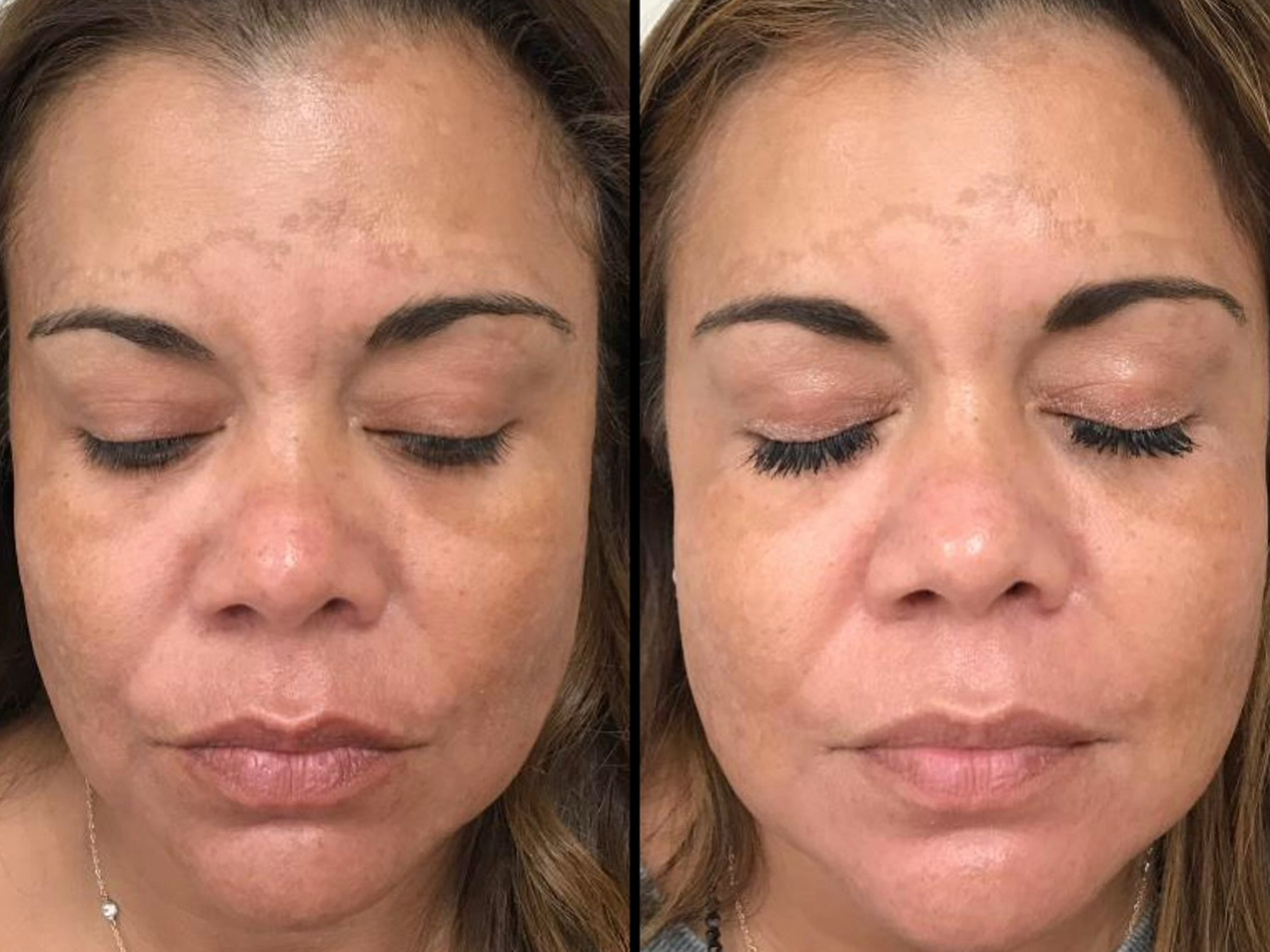 Side-by-side comparison of a woman's face, with the left showing her face before and the right after facial treatment, highlighting improved skin texture and tone.