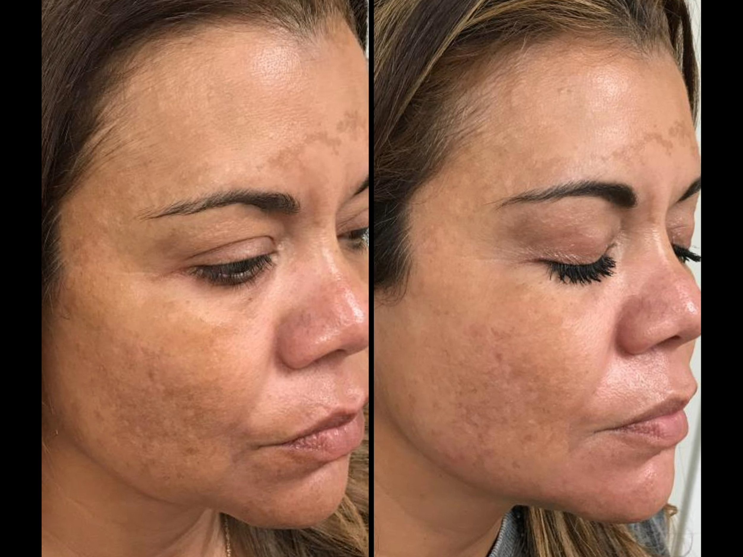 Side-by-side close-up images of a woman's face, showing skin before and after a skincare treatment, with visible improvement in skin texture and complexion.