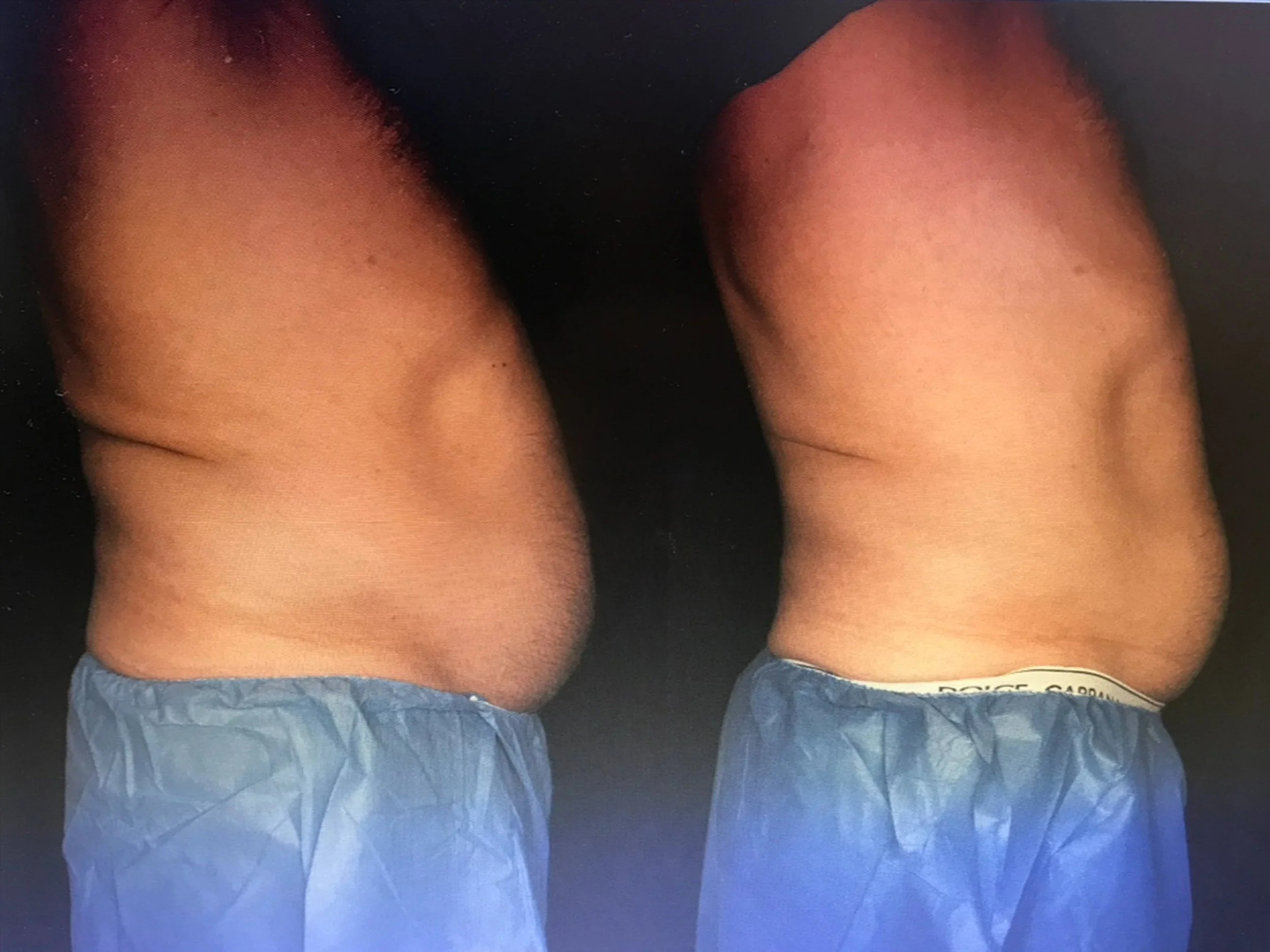 Side-by-side comparison of a person’s abdominal area before and after weight loss, both wearing blue shorts.