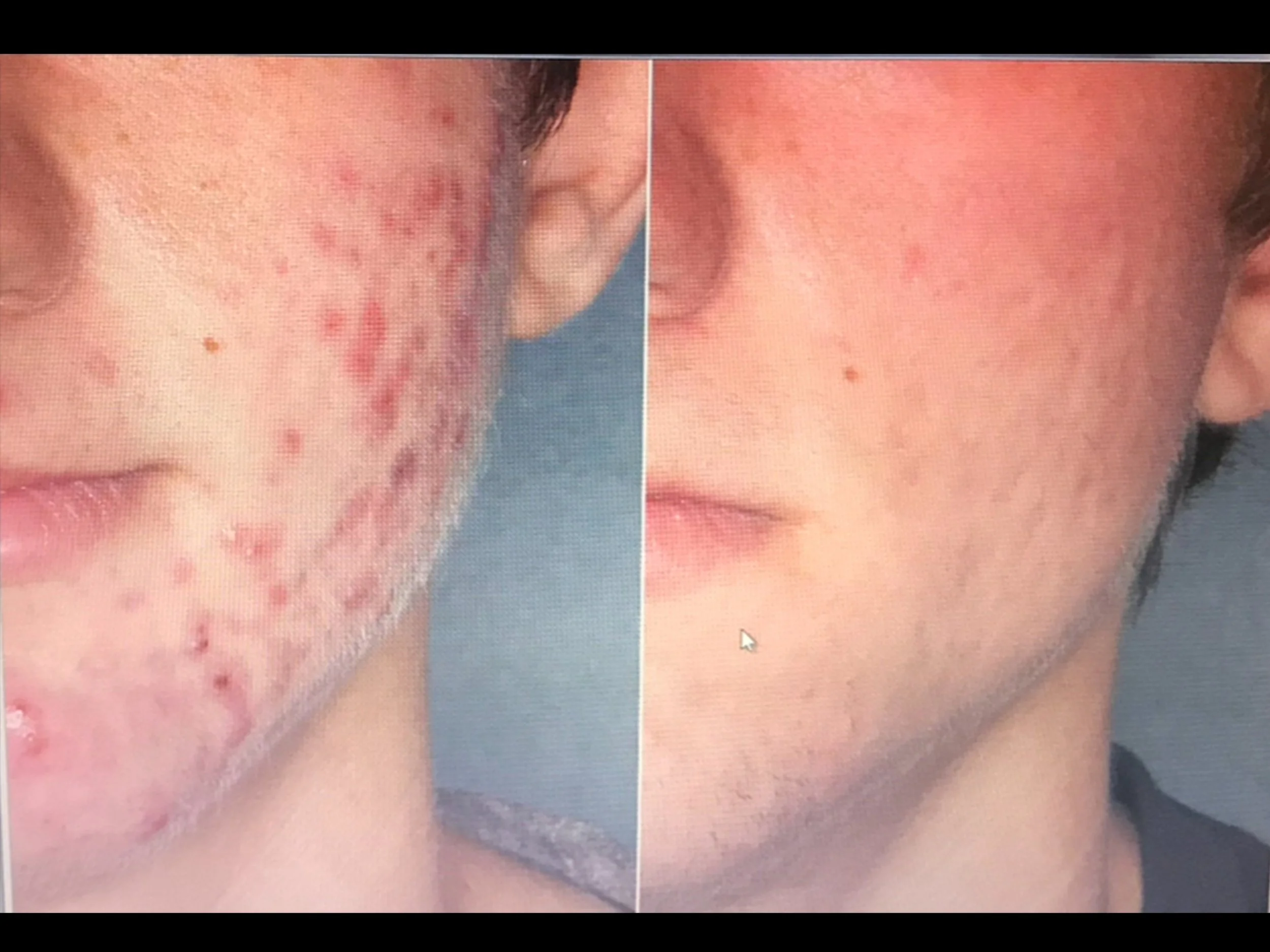 Side-by-side comparison of a person's face showing severe acne on the left and clear skin on the right, indicating skin improvement.