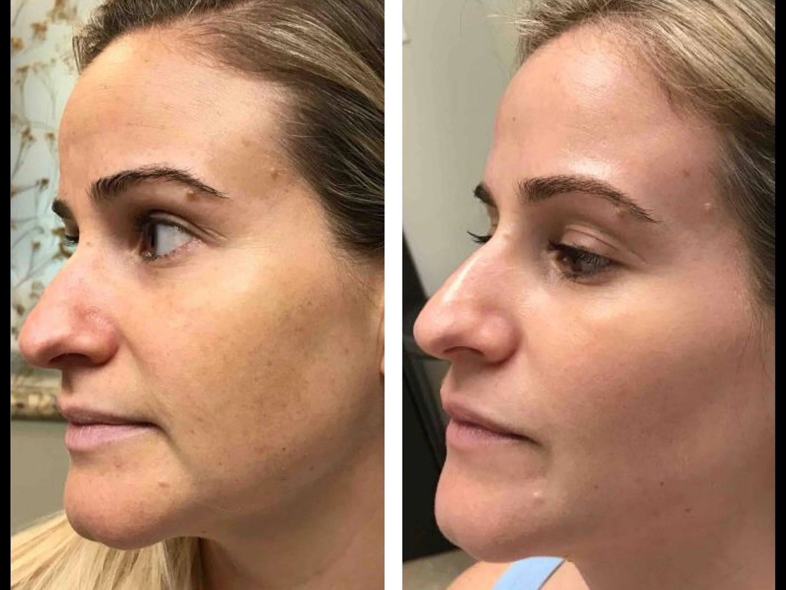 Side-by-side comparison photo of a woman's face showing skin improvement, before and after treatment.