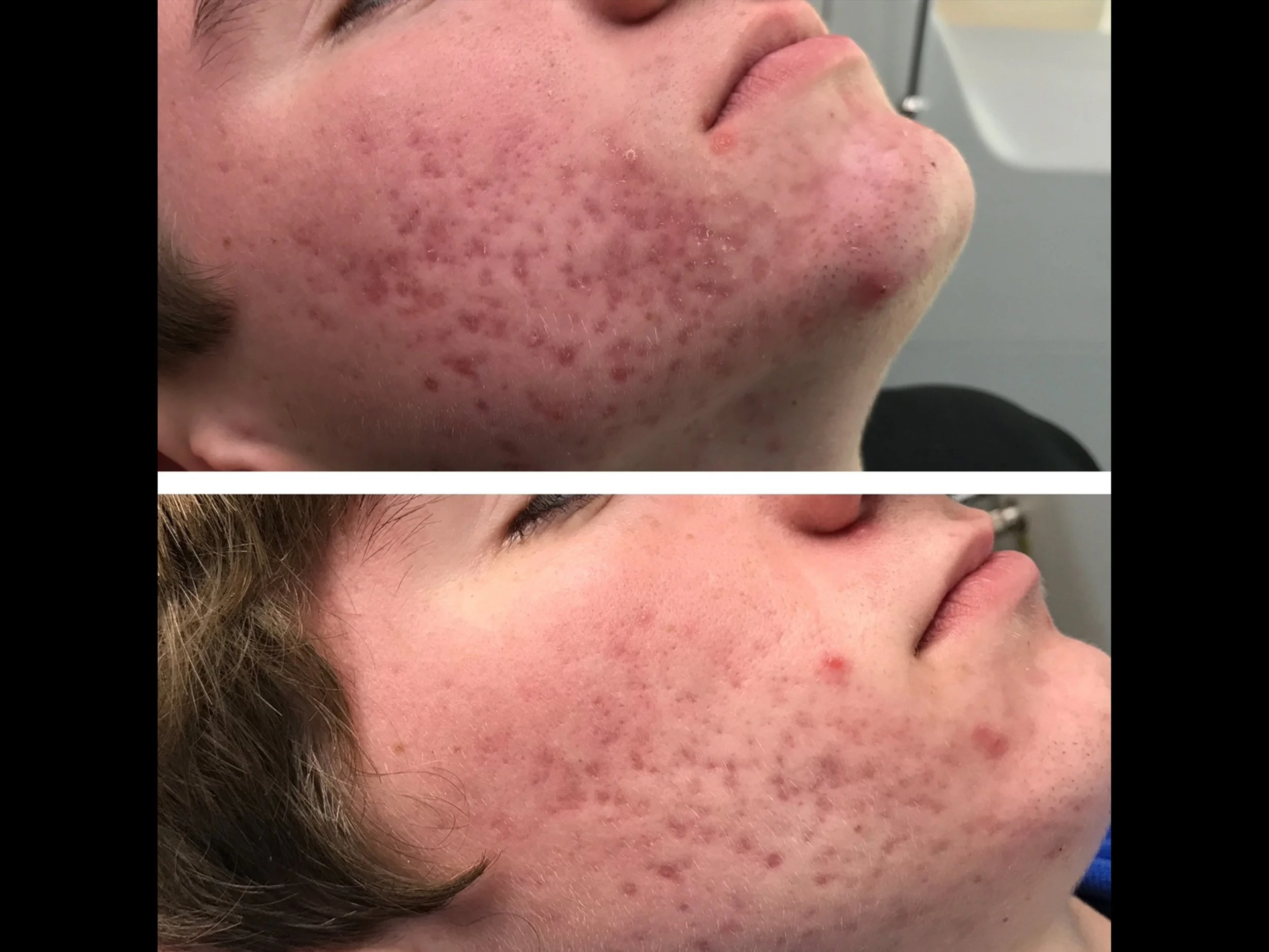 Comparison of a person's face before and after acne treatment, showing significant reduction in acne and skin redness.
