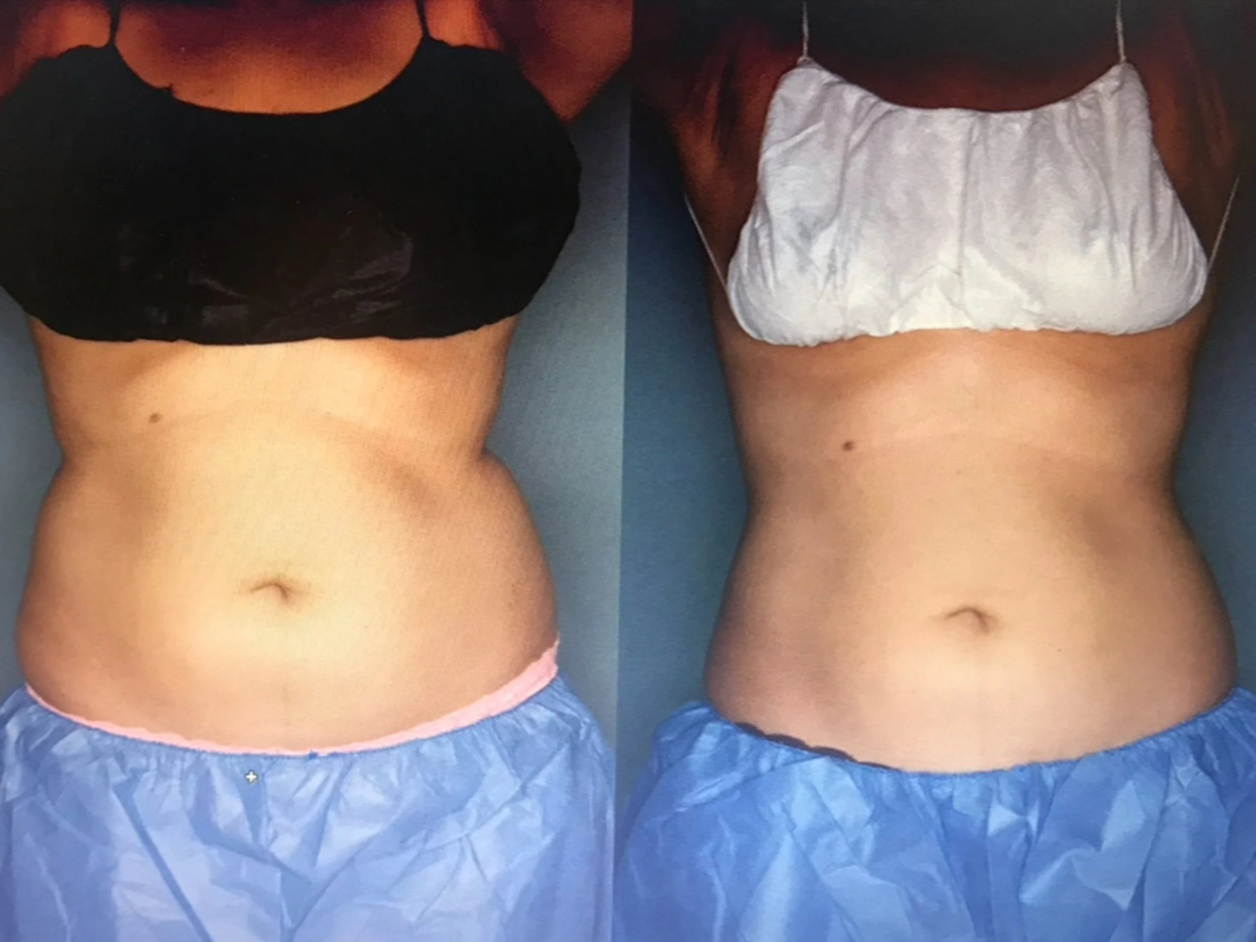 Comparison of a woman's abdomen before and after weight loss treatment, showing a slimmer waist on the right.