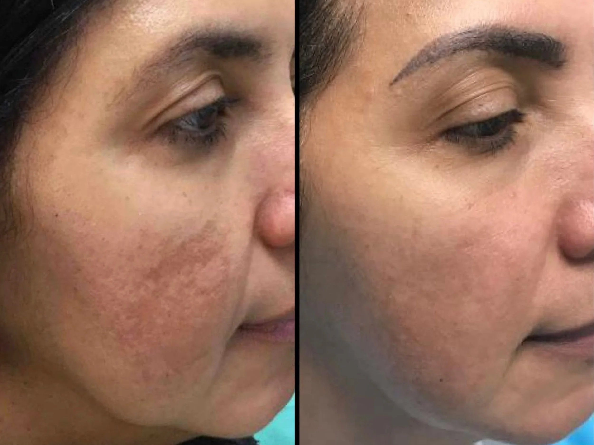 Side-by-side comparison of a woman's face showing skin before and after treatment, with improved skin clarity and texture in the after image.
