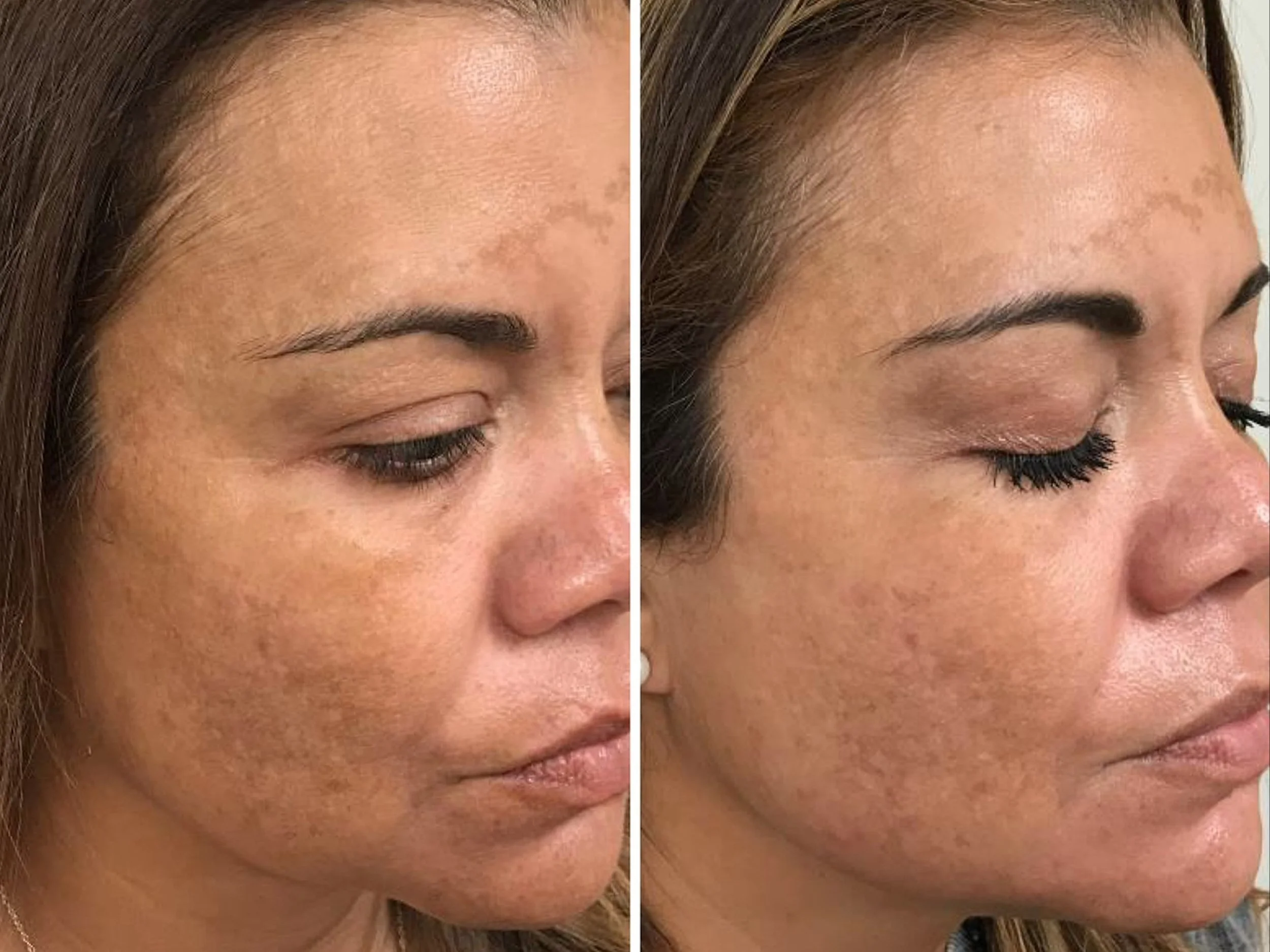A side-by-side comparison of a woman's face before and after skincare treatment, showing reduced redness and hyperpigmentation in the after photo.