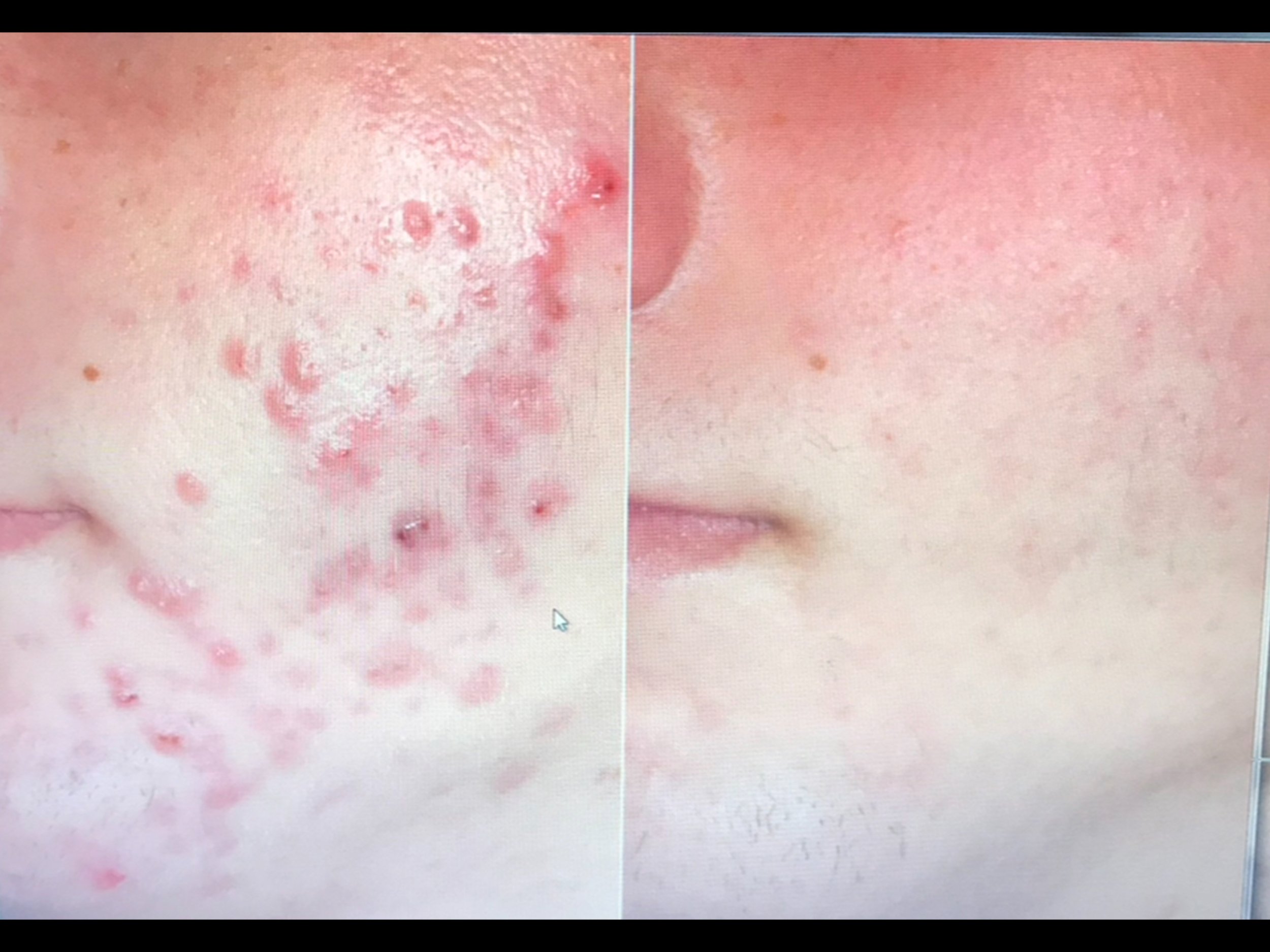 Comparison of a person's face with severe acne and redness on the left side, and clear skin with minimal redness on the right side.