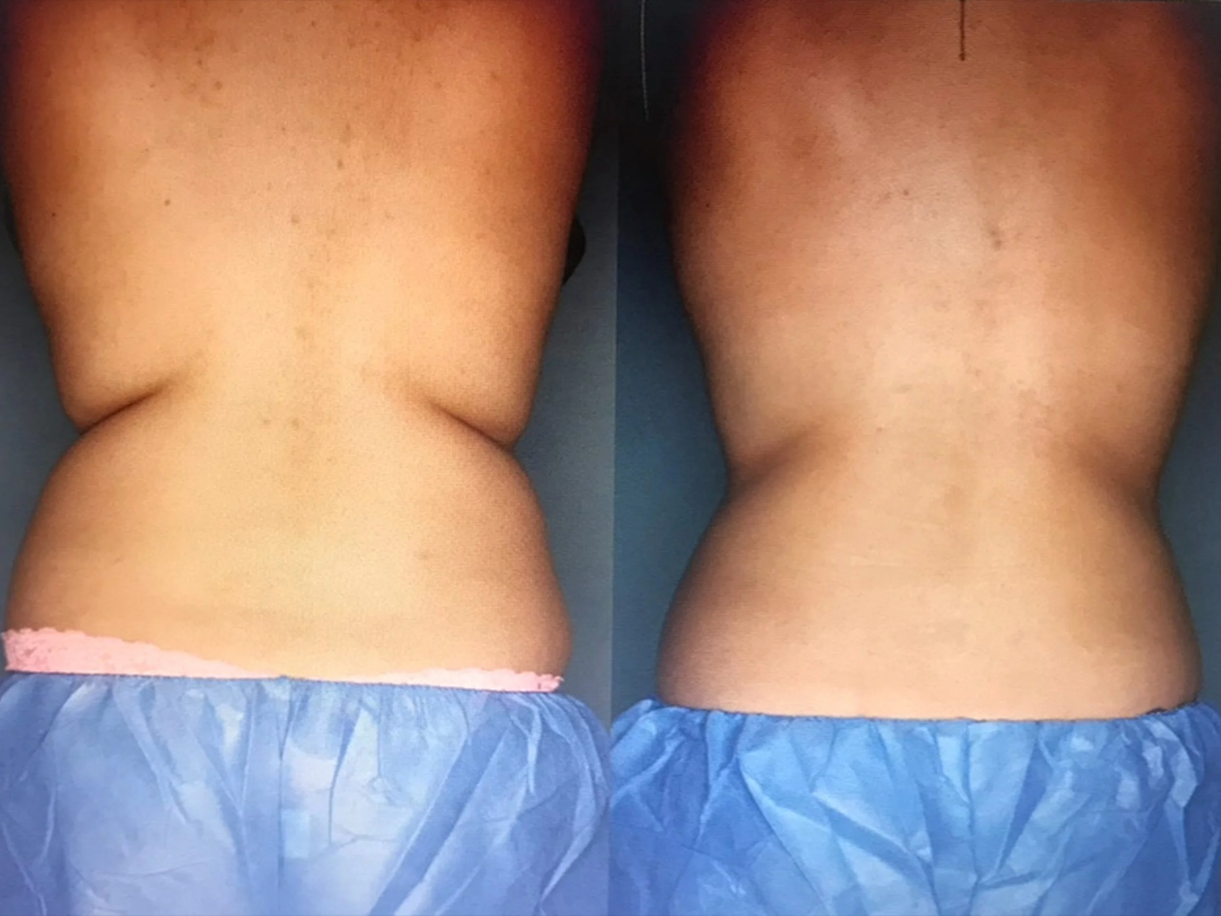 Comparison of a person's back before and after a treatment or exercise, showing reduced fat or improved muscle tone.