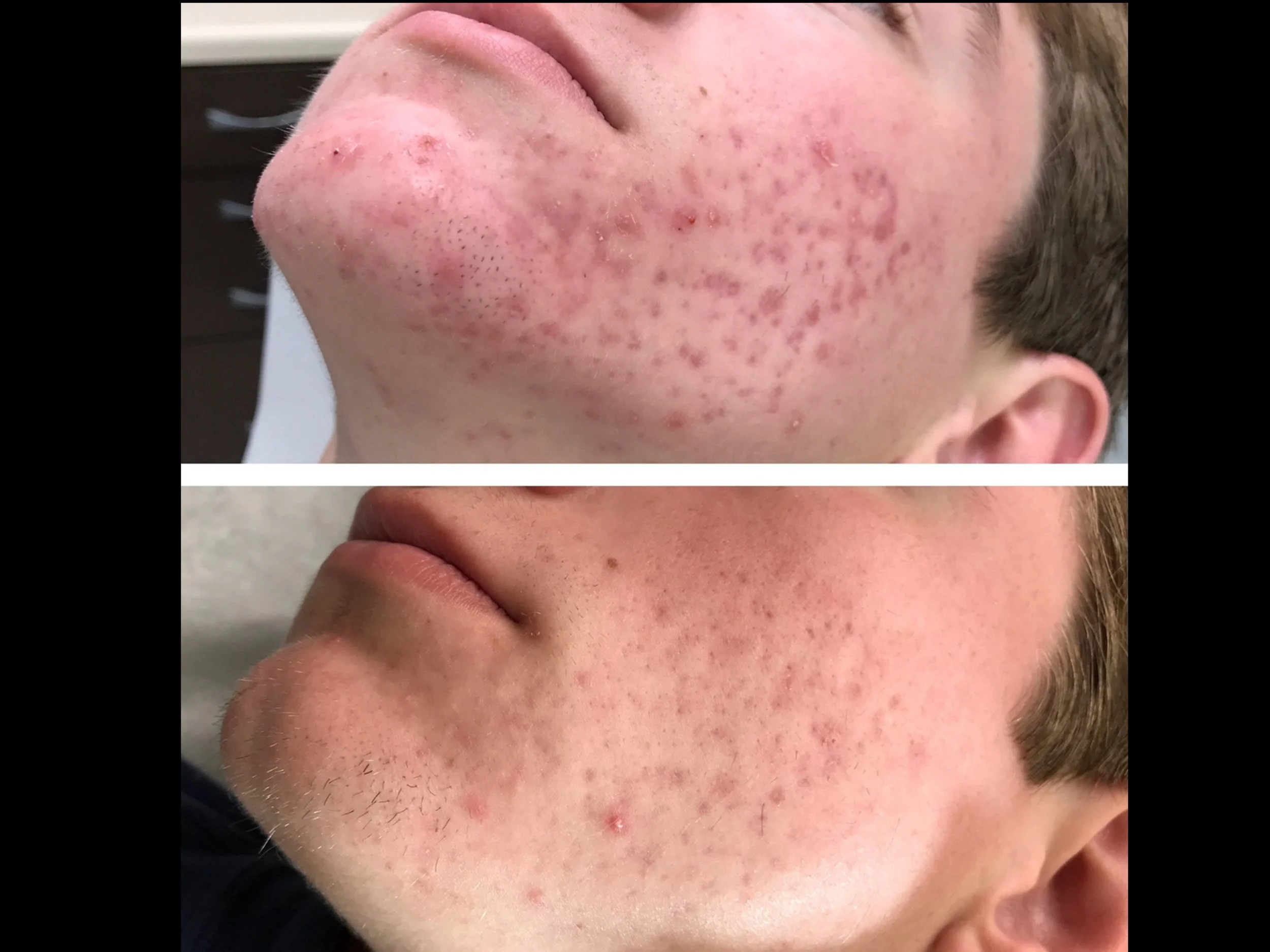 Comparison of a person's face before and after acne treatment, showing significant reduction in acne and skin inflammation.