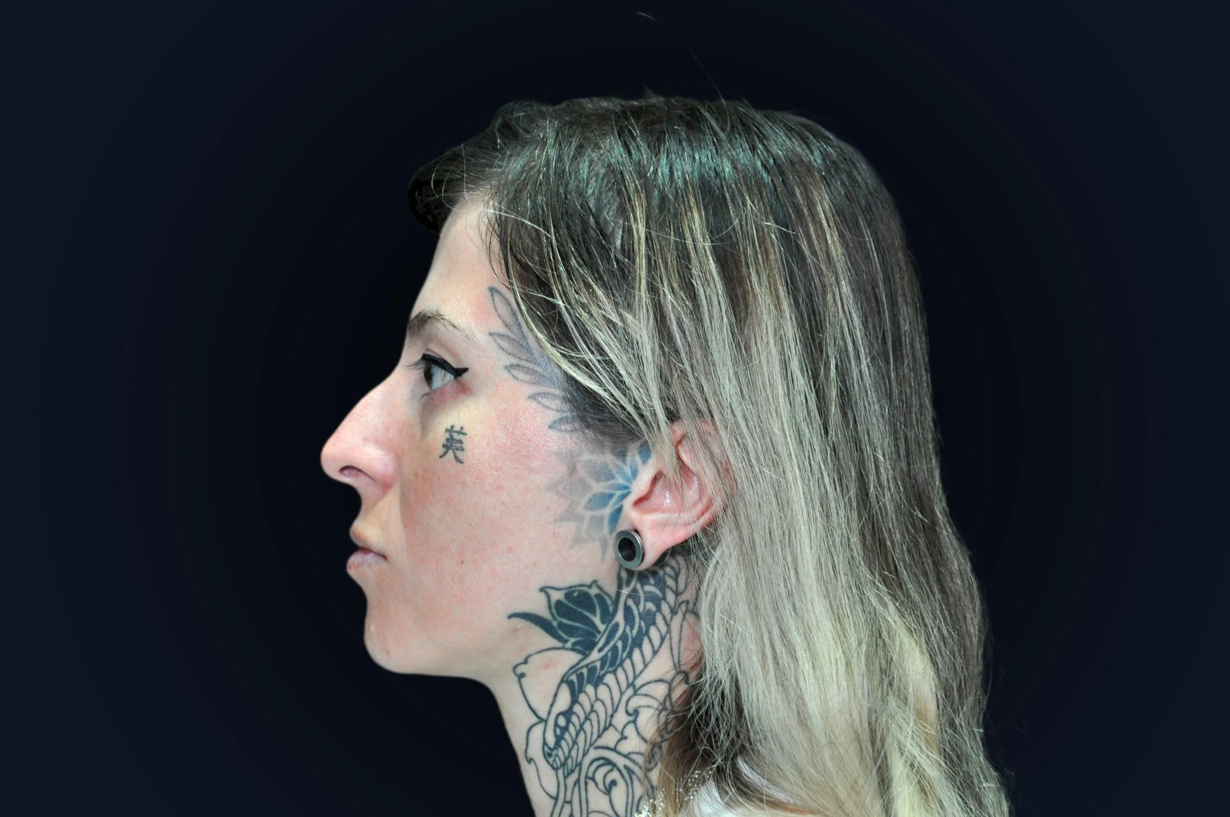 Antes de rinoplastia